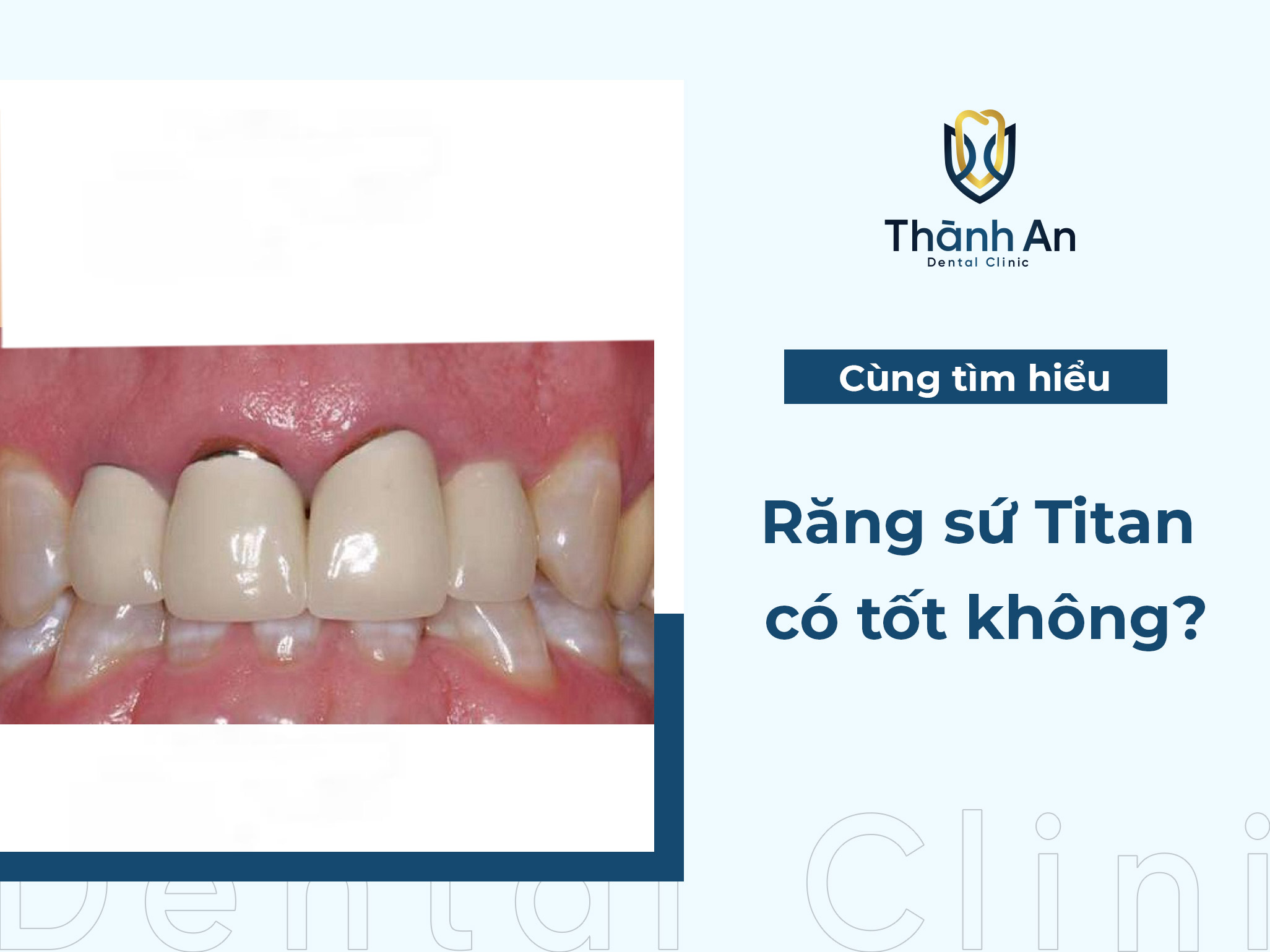 Răng sứ Titan có tốt không? Nên bọc răng loại nào?