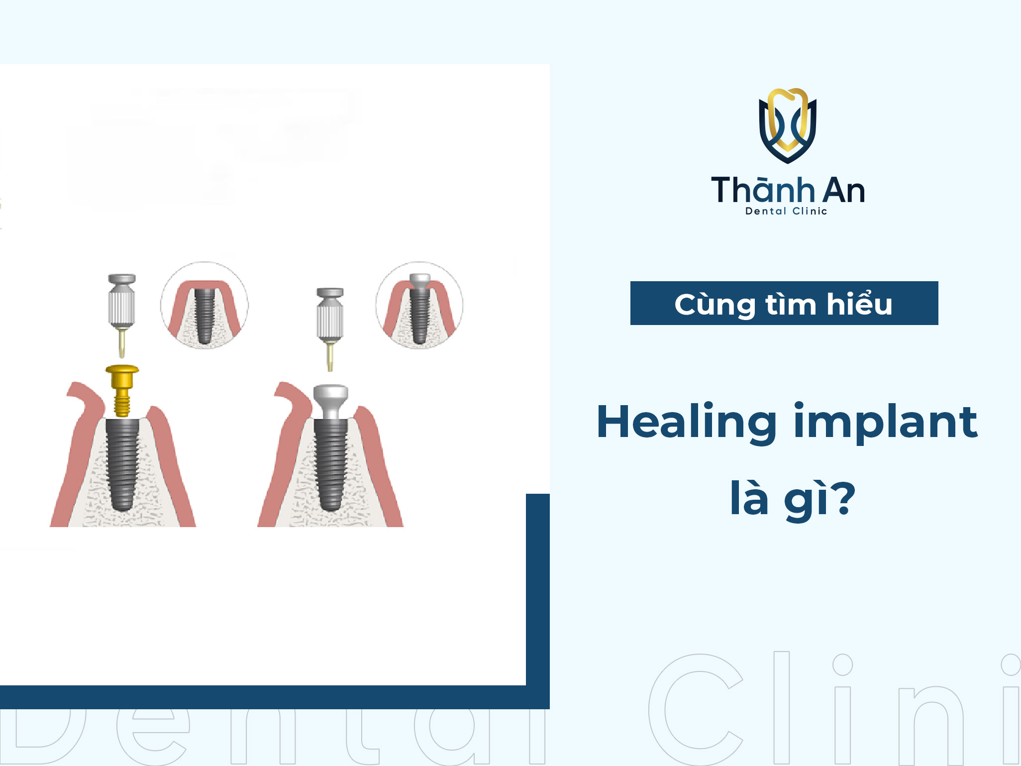 Healing implant là gì? Vai trò quan trọng của Healing