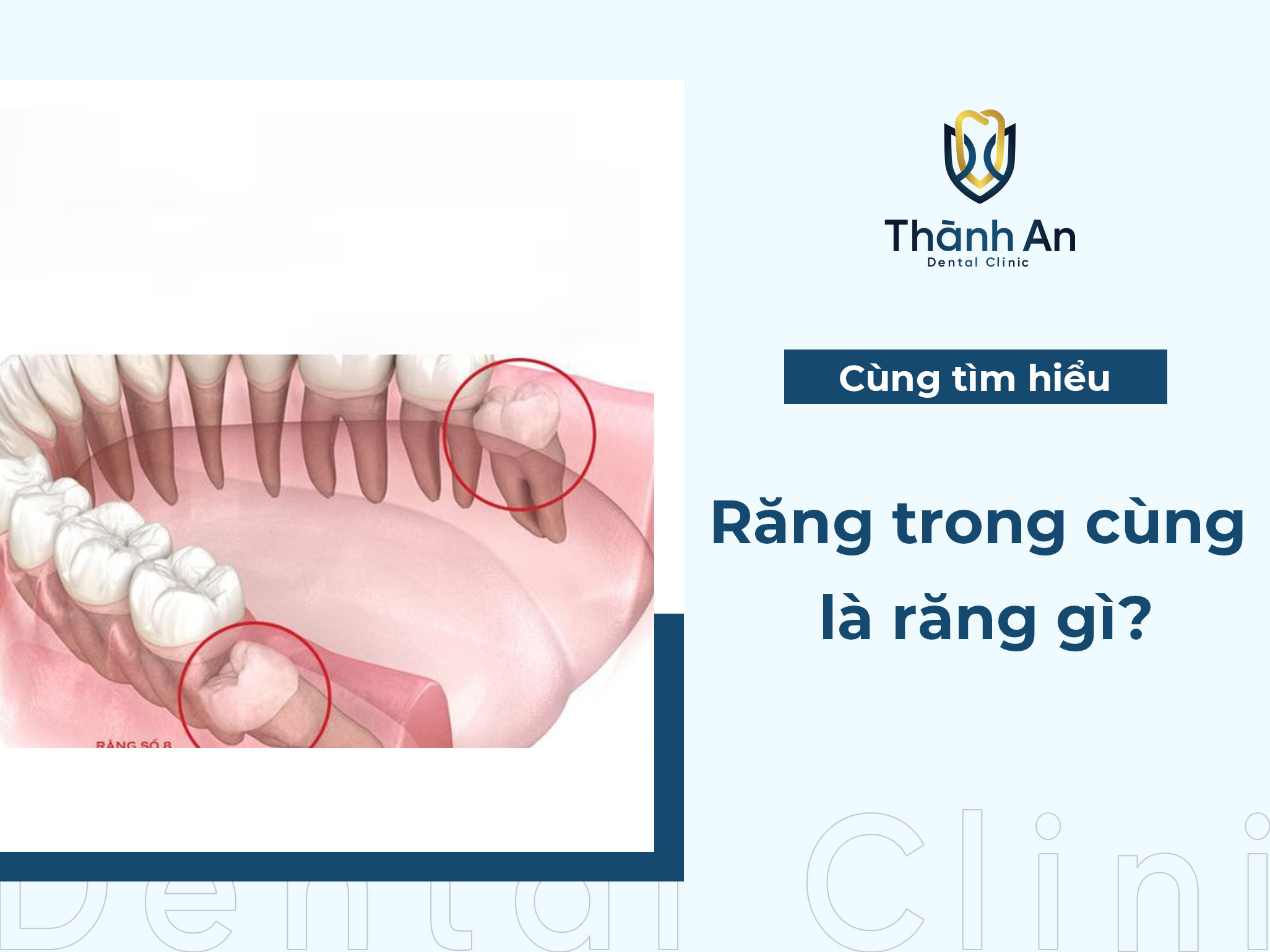 Răng trong cùng là răng gì? Có nên nhổ răng này hay không