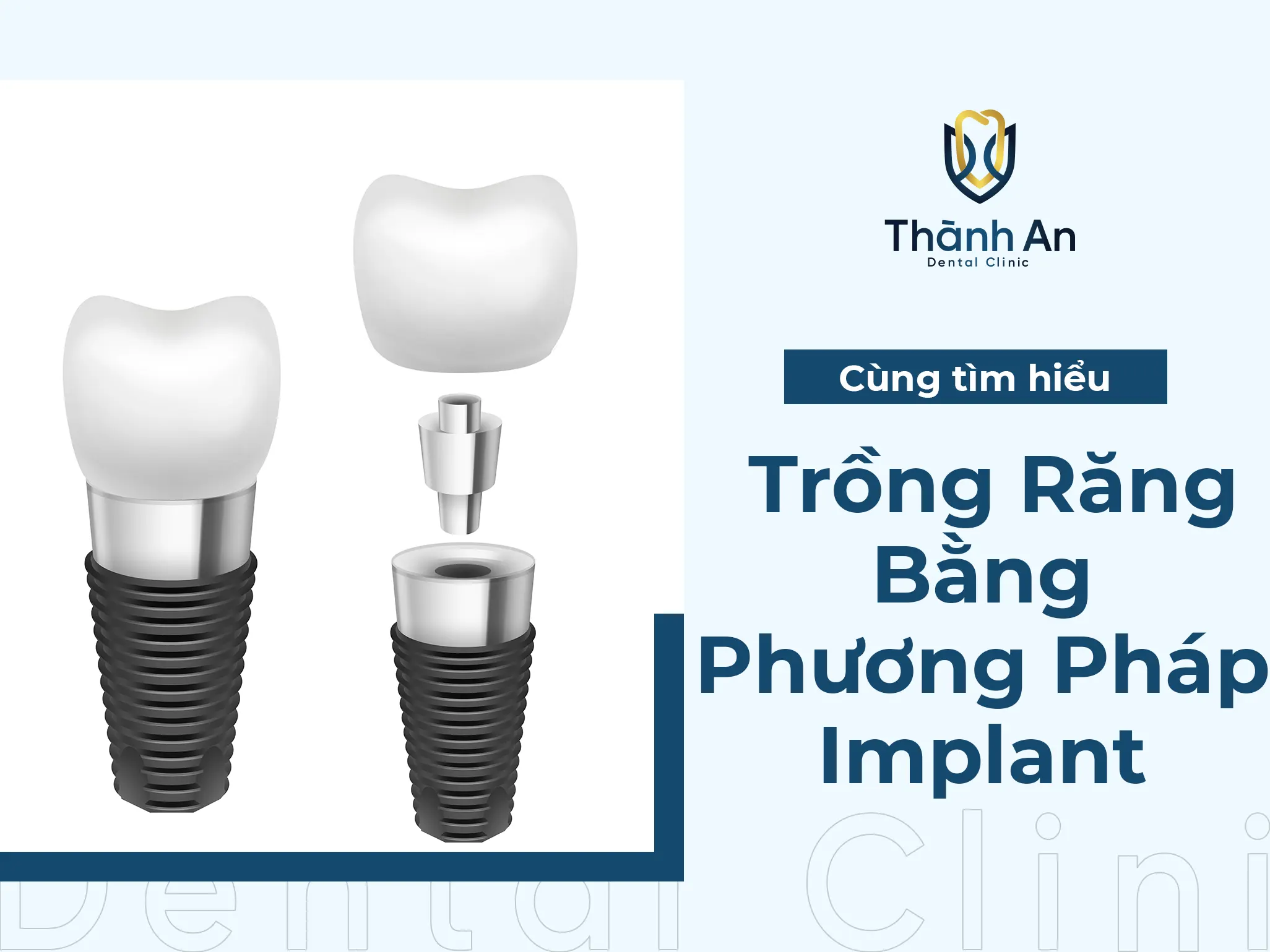 Trồng Răng Implant Là Gì? Quy Trình Làm Răng Implant?