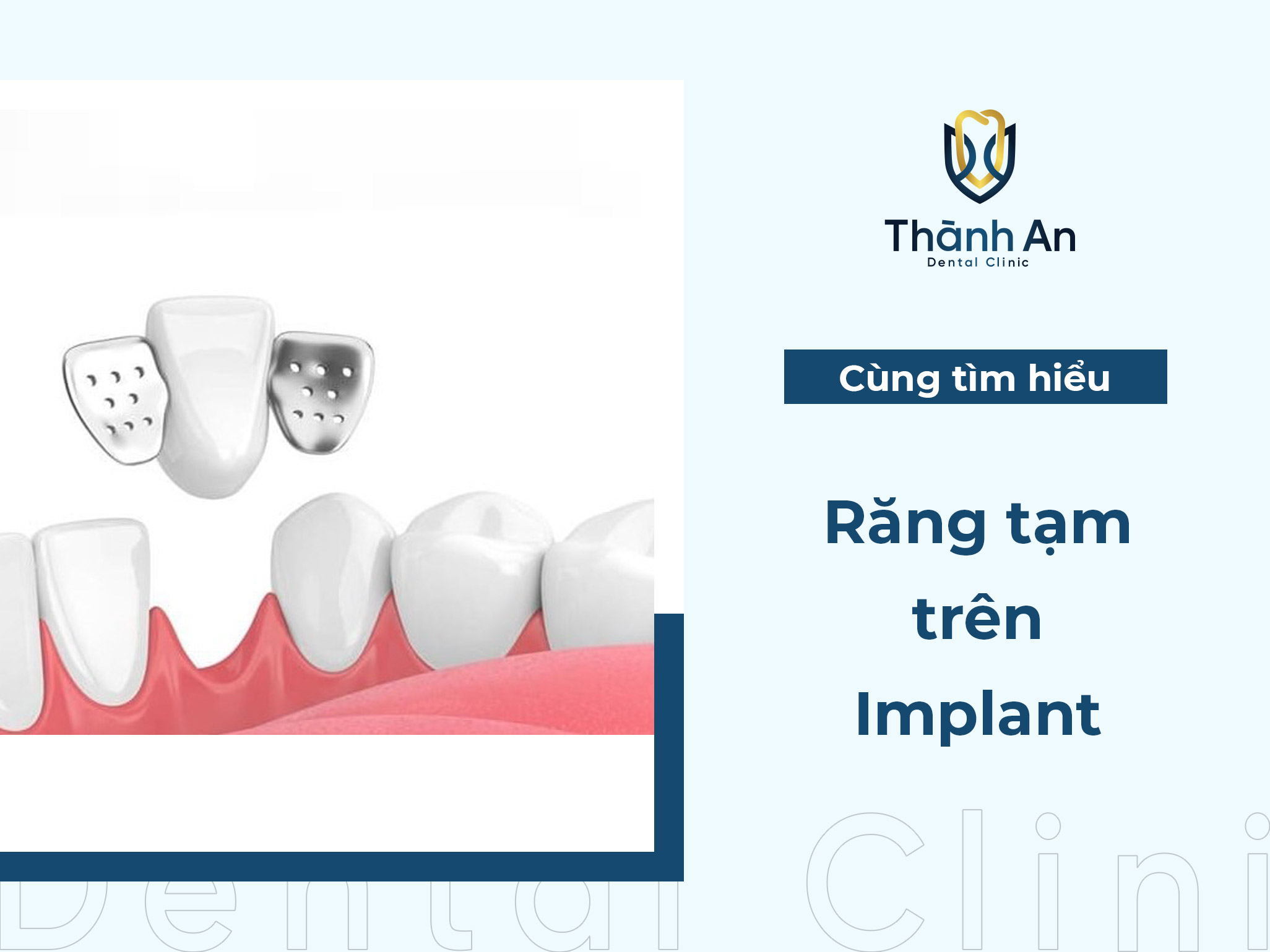 Răng tạm trên Implant là gì? Có mấy loại?  lưu ý cần biết