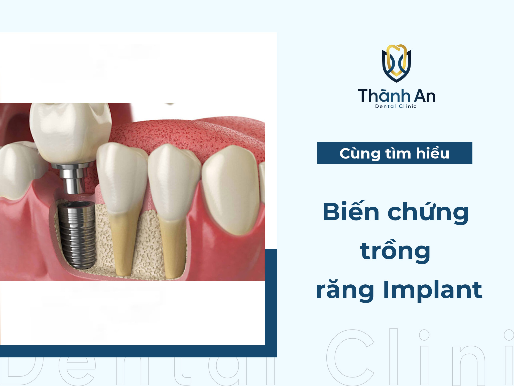 Biến chứng và tác hại của việc trồng răng Implant là gì?
