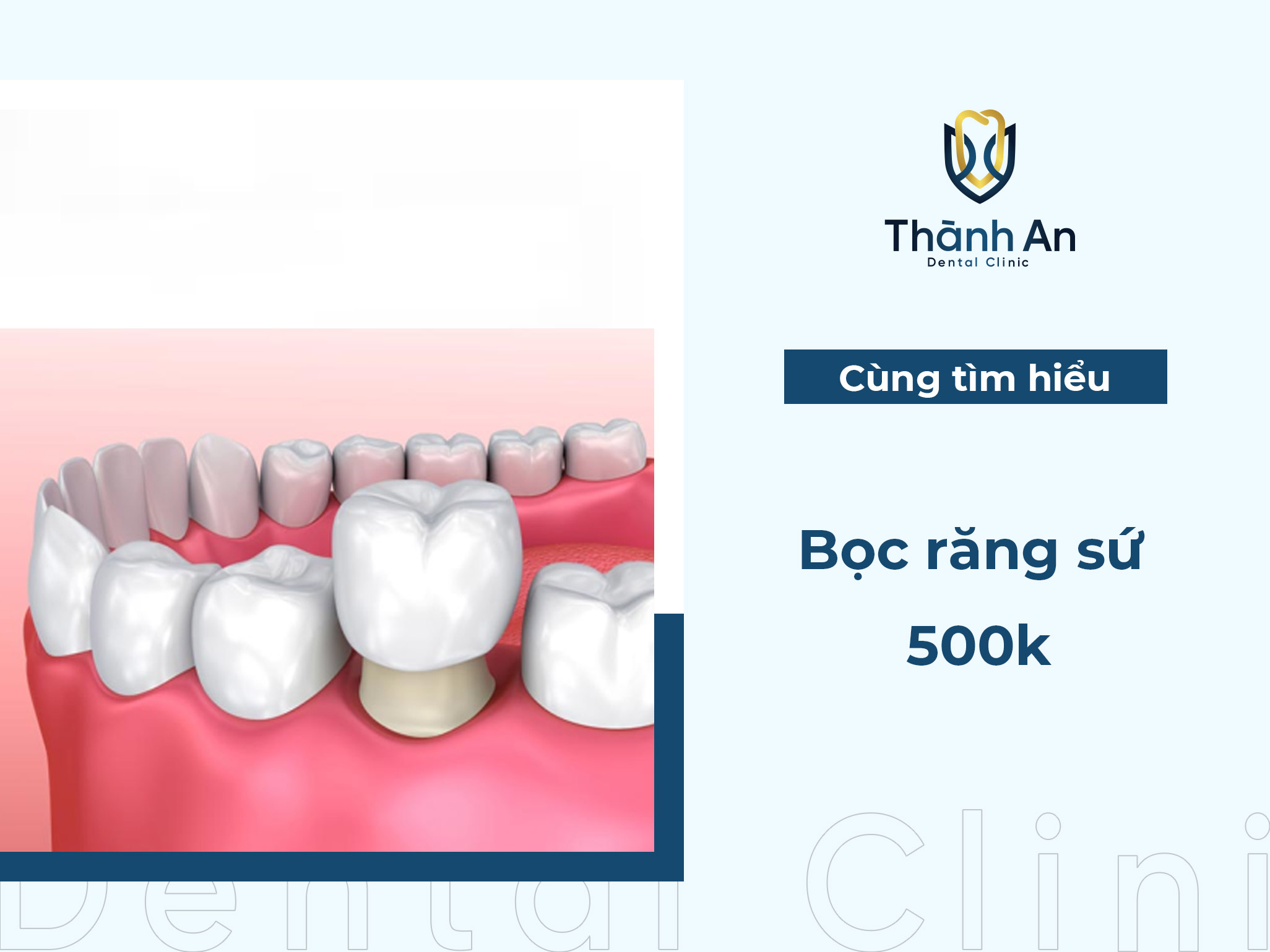 7. Quy trình thực hiện bọc răng sứ