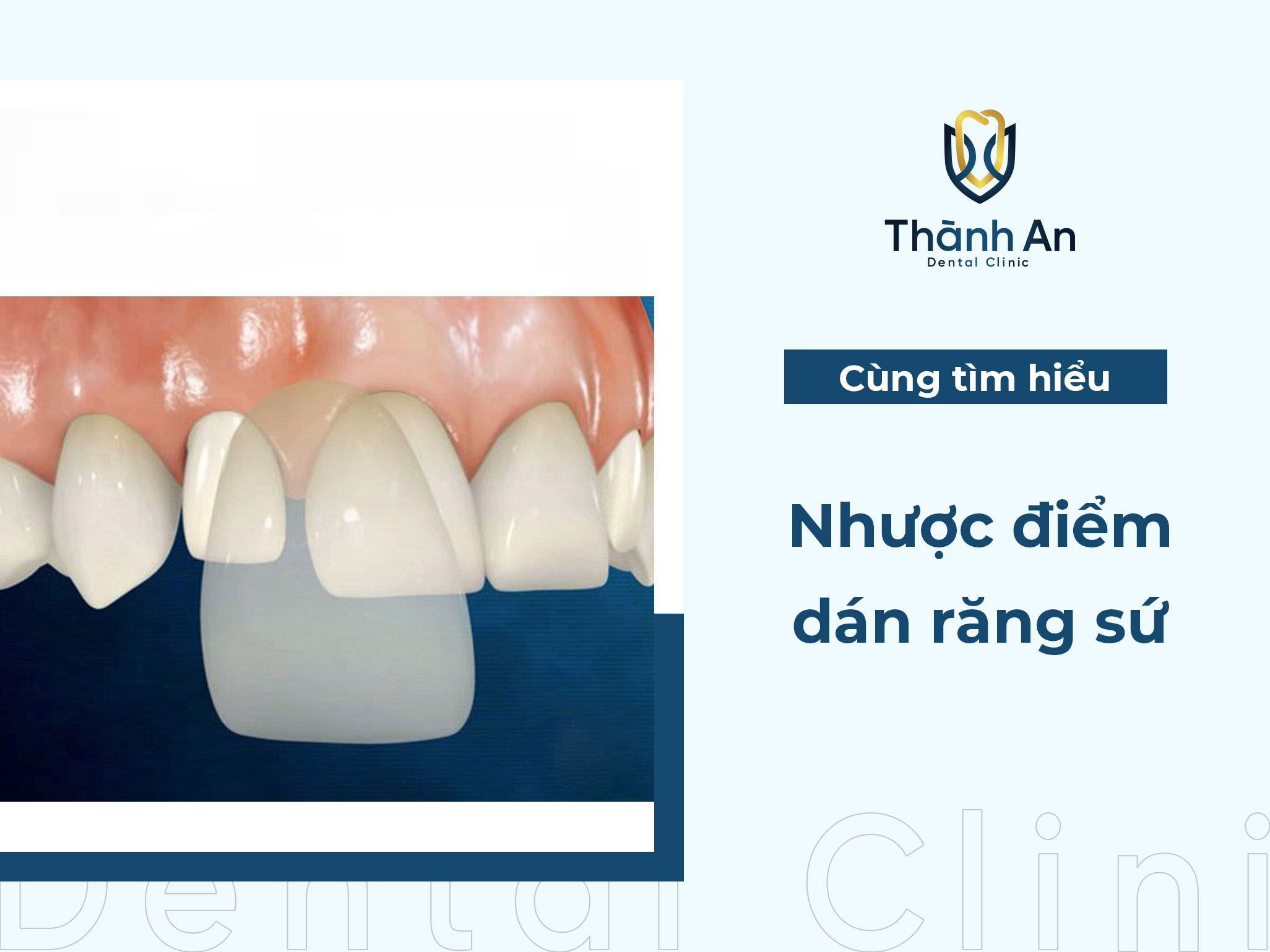  Top 4 nhược điểm của dán răng sứ trước khi thực hiện, bạn nên biết