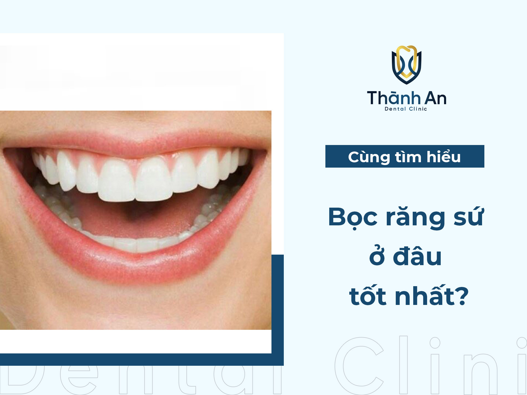 Bọc răng sứ ở đâu tốt nhất? Top 5+ Địa Chỉ Uy Tín tại Hà Nội