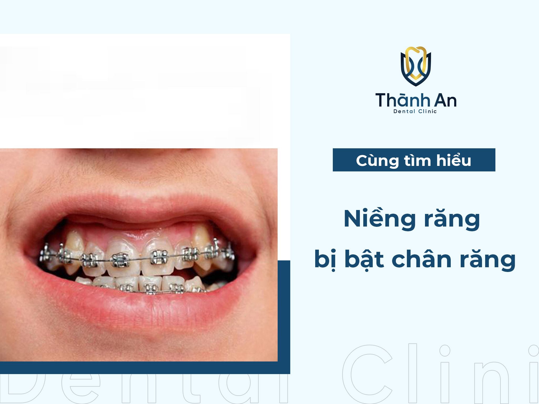 Bật chân răng khi niềng: Nguyên nhân và giải pháp khắc phục