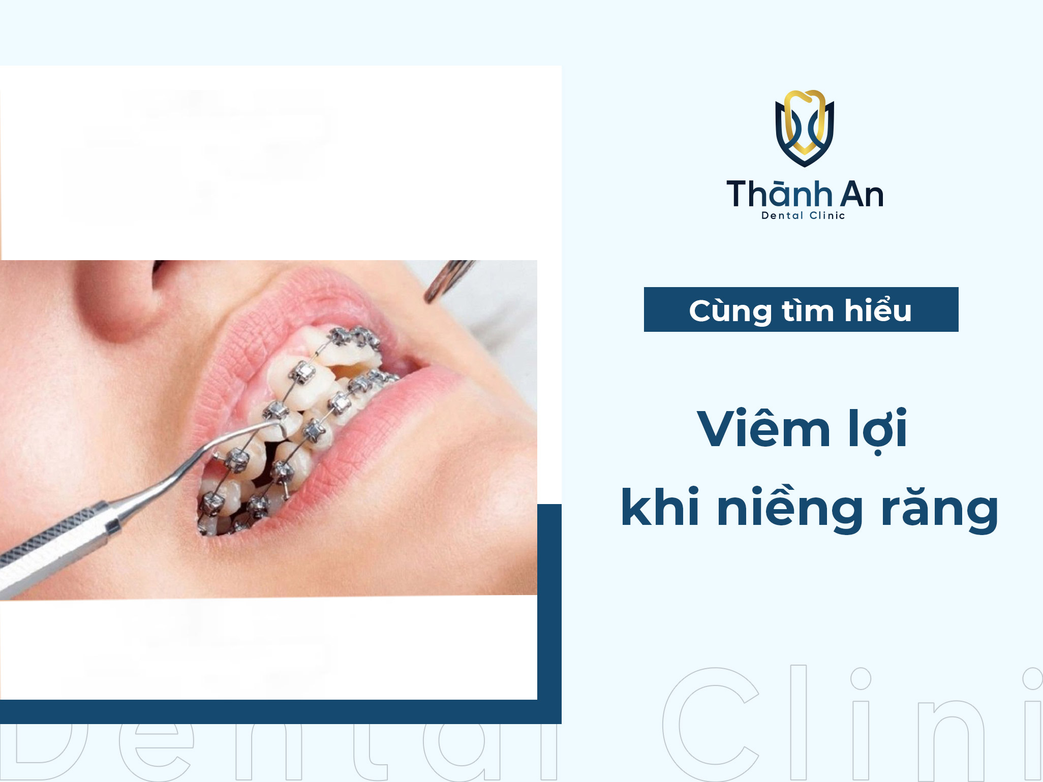 Viêm lợi khi niềng răng do đâu? Cách trị viêm lợi hiệu quả
