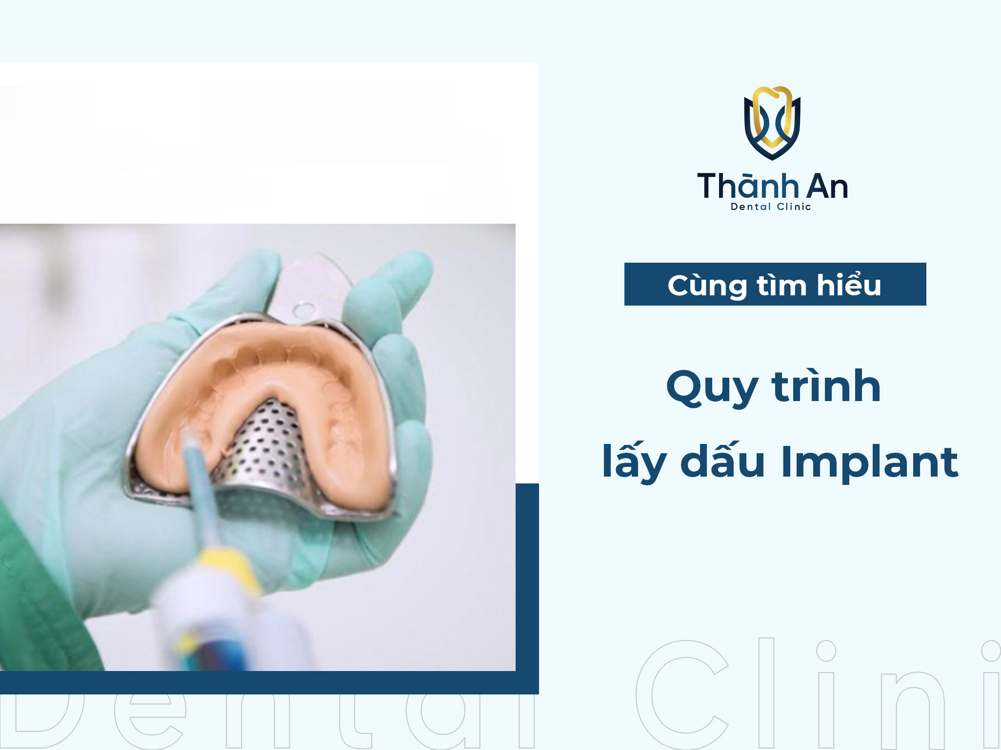 Lấy dấu Implant là gì? Quy trình lấy dấu Implant 