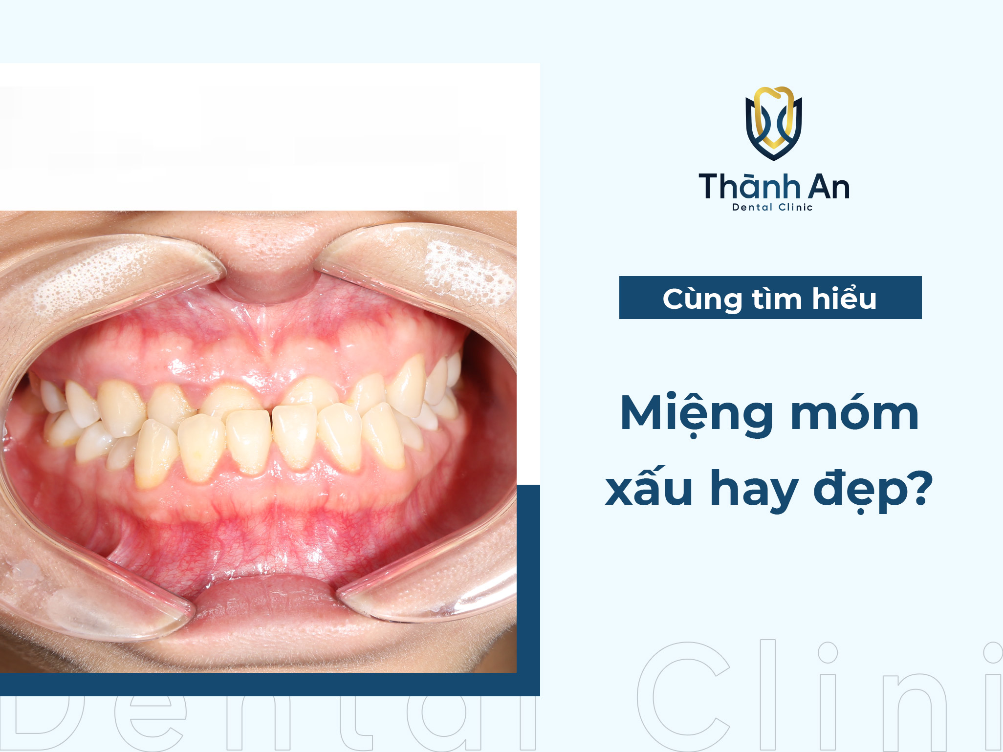 Miệng móm Xấu hay Đẹp? miệng móm trong nhân tướng học