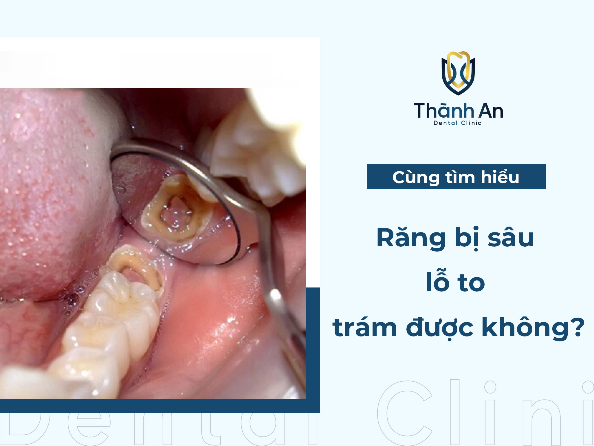 [Hỏi- Đáp] Răng bị sâu lỗ to trám được không?