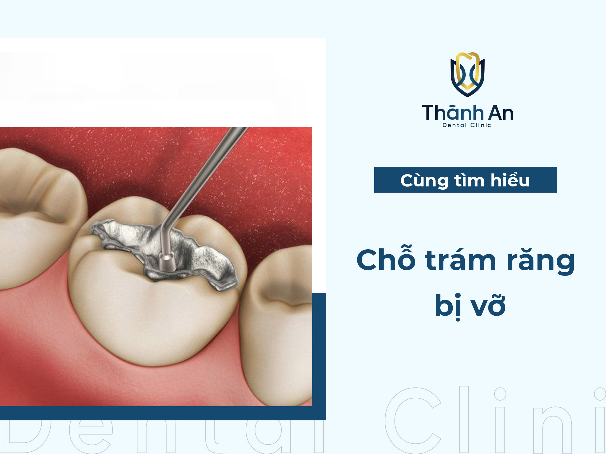 Chỗ trám răng bị vỡ: Nguyên nhân và  giải pháp xử lí HIỆU QUẢ 