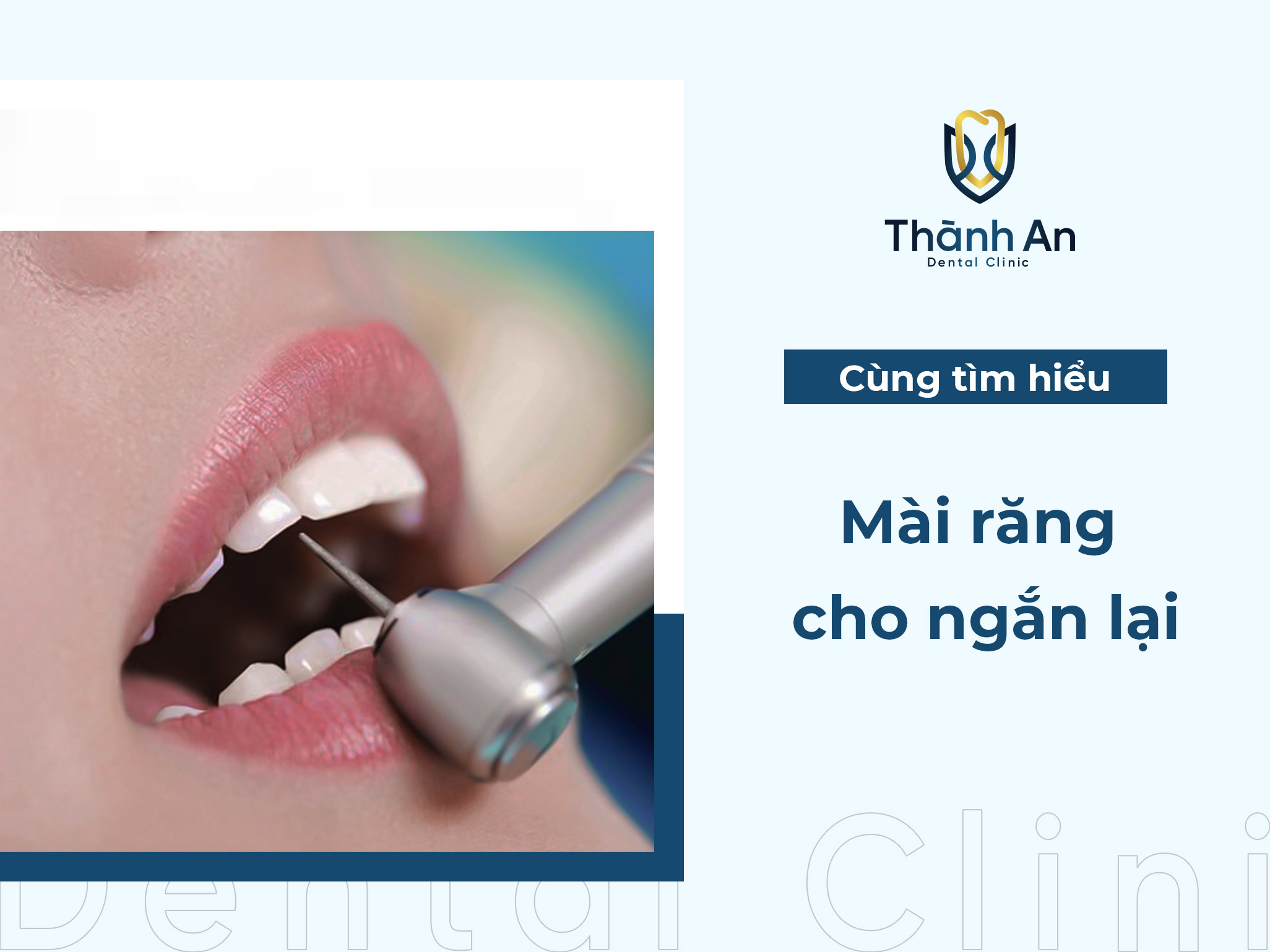 Khi nào cần mài răng ngắn lại? Quy trình và lưu ý cần biết