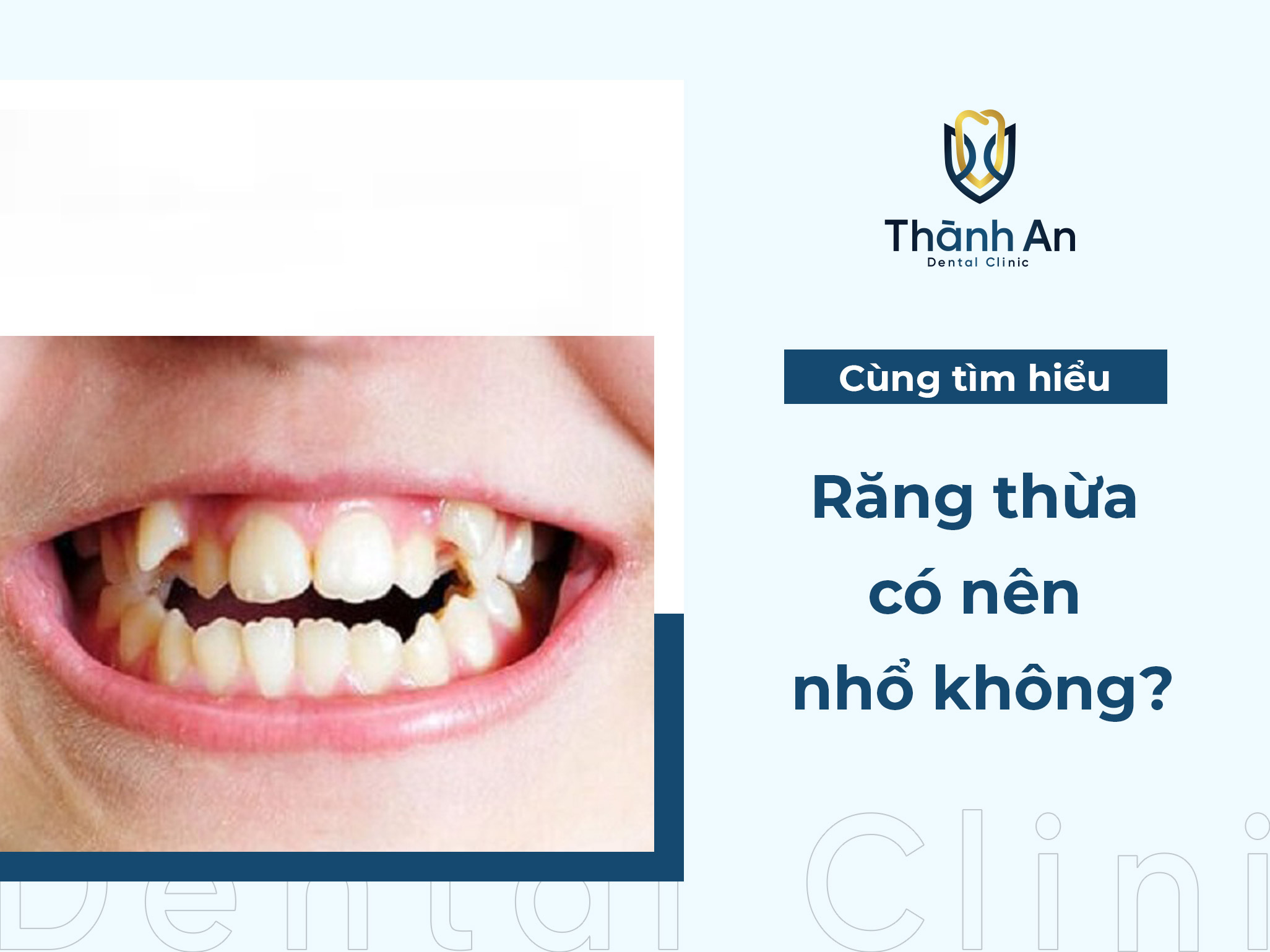 Răng thừa có nên nhổ không? Cần lưu ý gì?