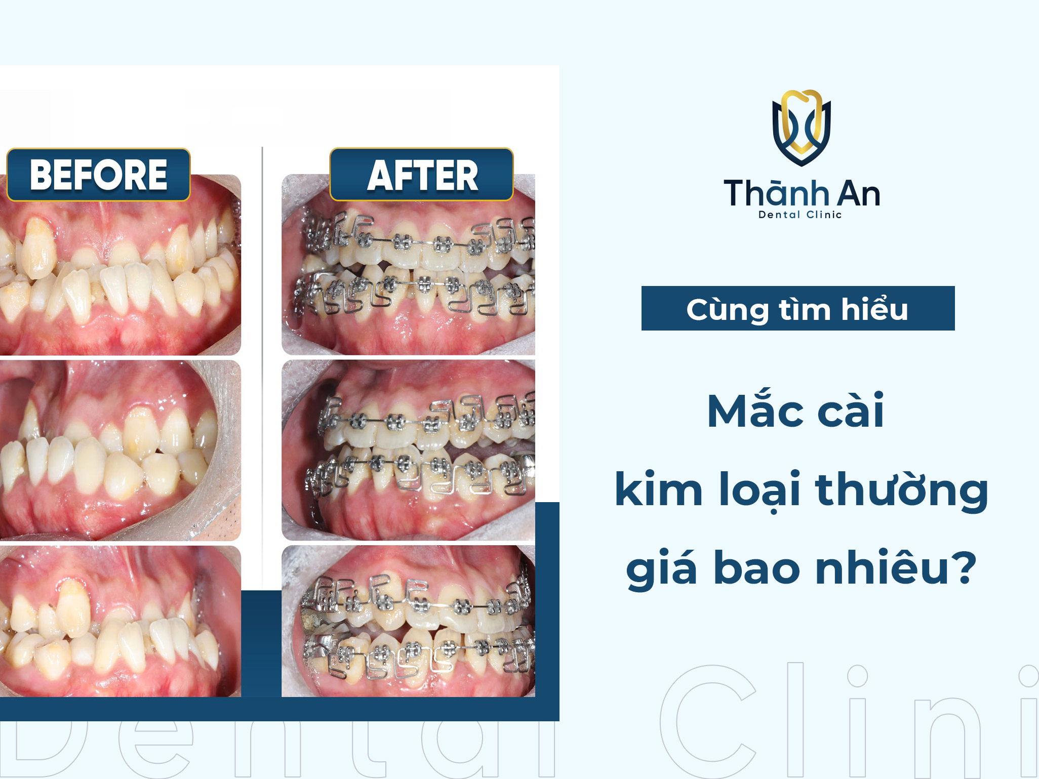 Niềng răng mắc cài kim loại thường là gì? giá bao nhiêu?