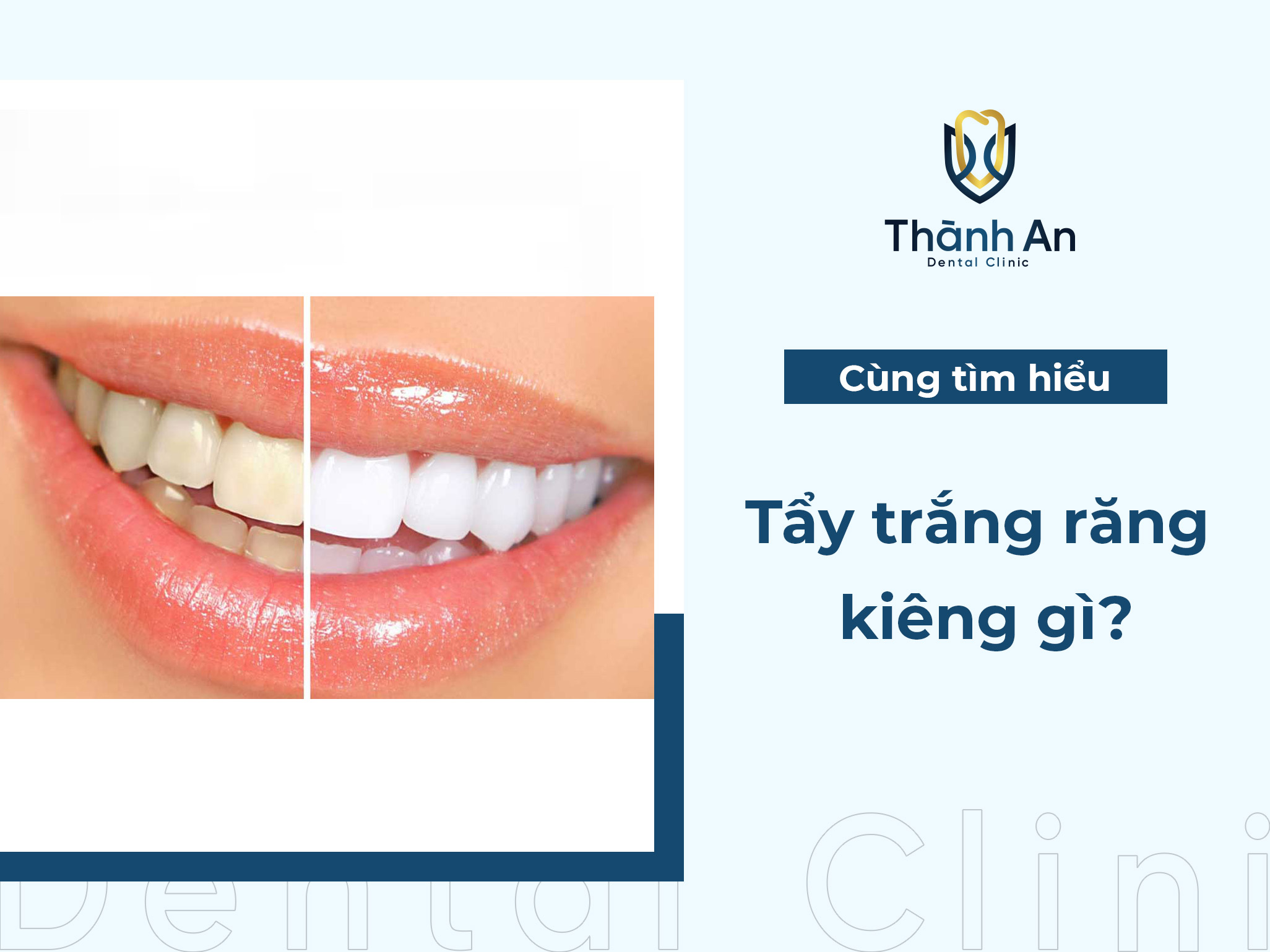 Tẩy trắng răng kiêng gì? Những lưu ý sau khi tẩy trắng răng 