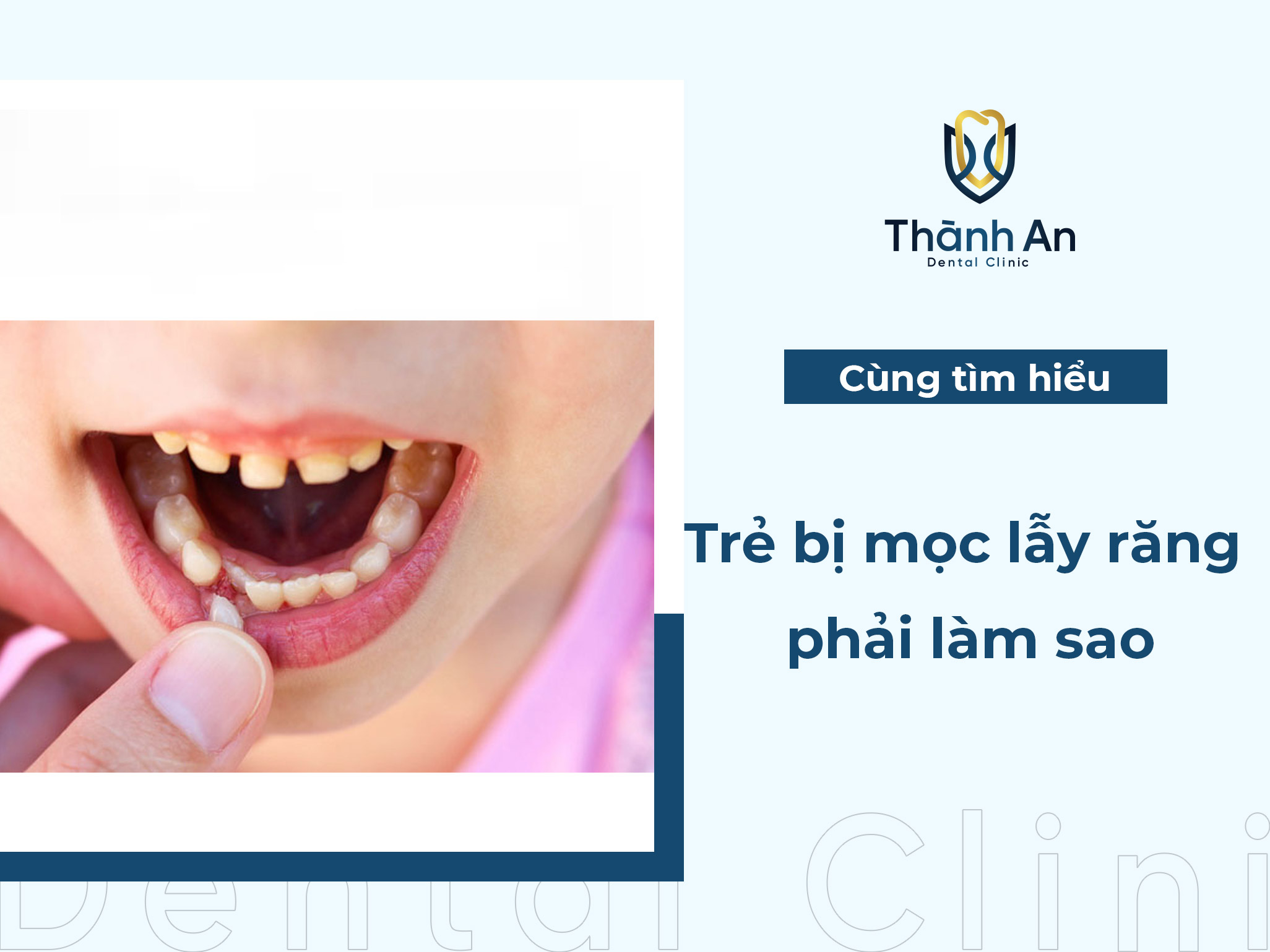 Răng mọc lẫy ở trẻ - Giải pháp nào an toàn và hiệu quả?