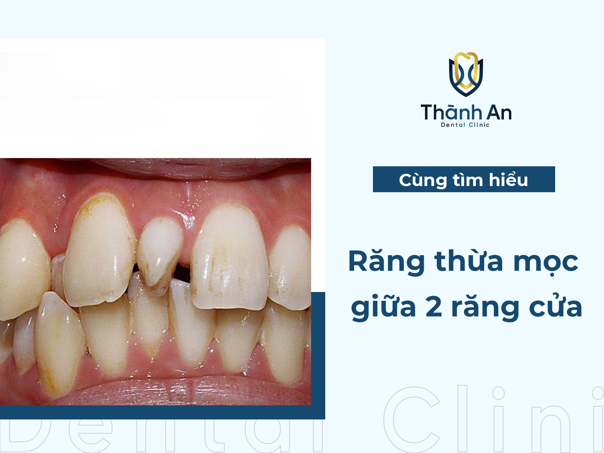 Răng thừa mọc giữa 2 răng cửa: Nguyên nhân và cách khắc phục 