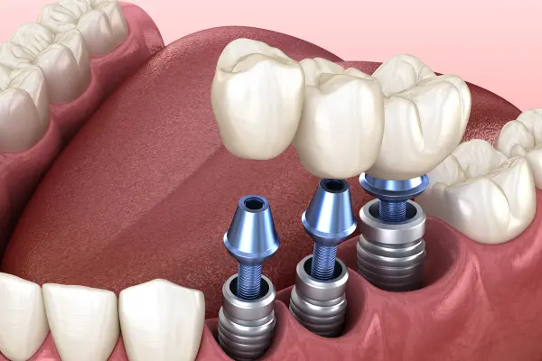 tre-em-trong-rang-implant-duoc-khong