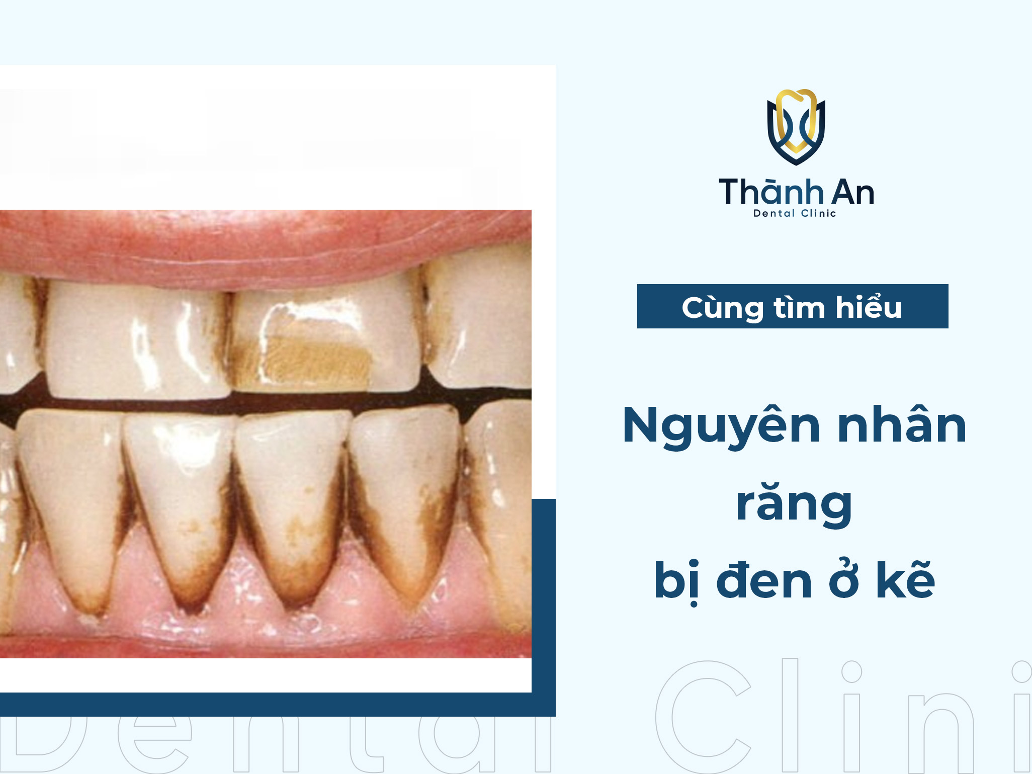 Nguyên nhân răng bị đen ở kẽ và cách khắc phục hiệu quả