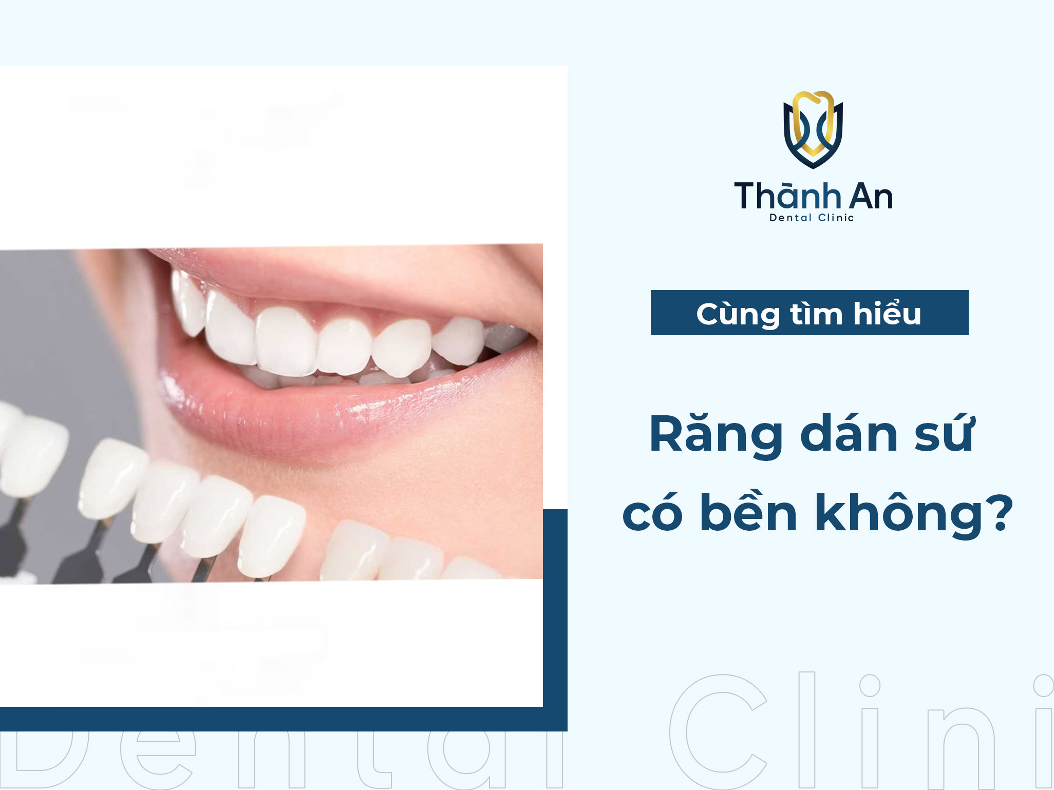 Răng dán sứ có bền không? Quy trình dán răng sứ chuẩn Y khoa