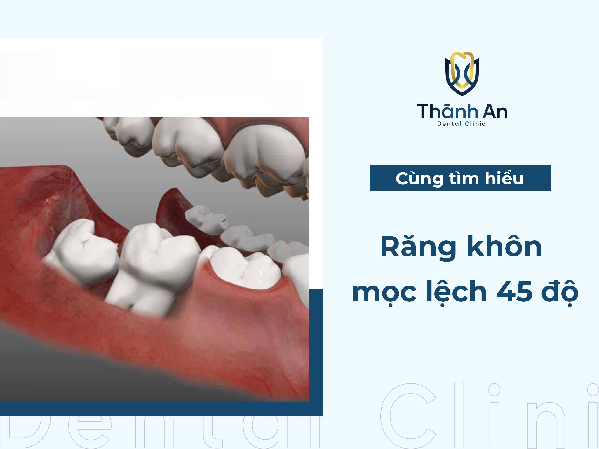 Răng khôn mọc lệch 45 độ có nên nhổ hay không?