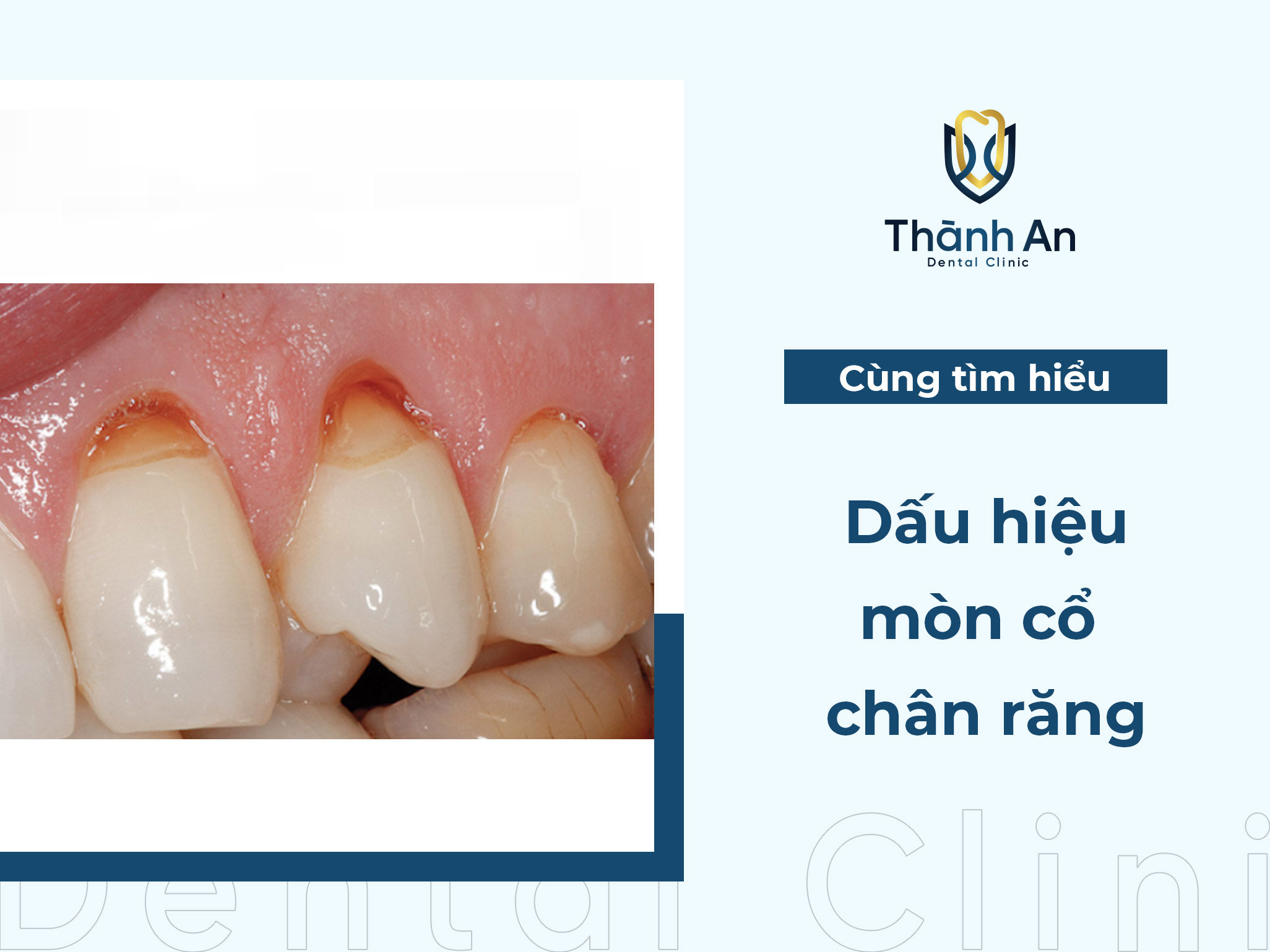 Mòn cổ chân răng: Nguyên nhân, dấu hiệu và phương pháp điều trị