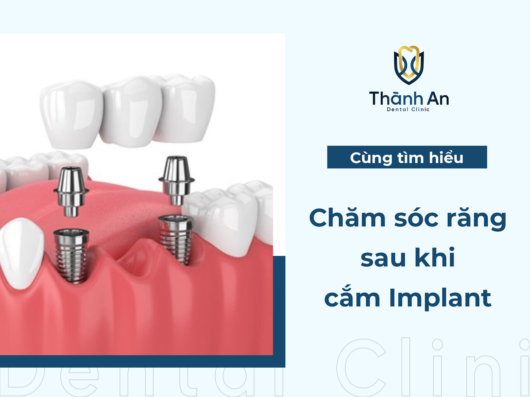 Cách chăm sóc răng sau khi cắm implant hiệu quả