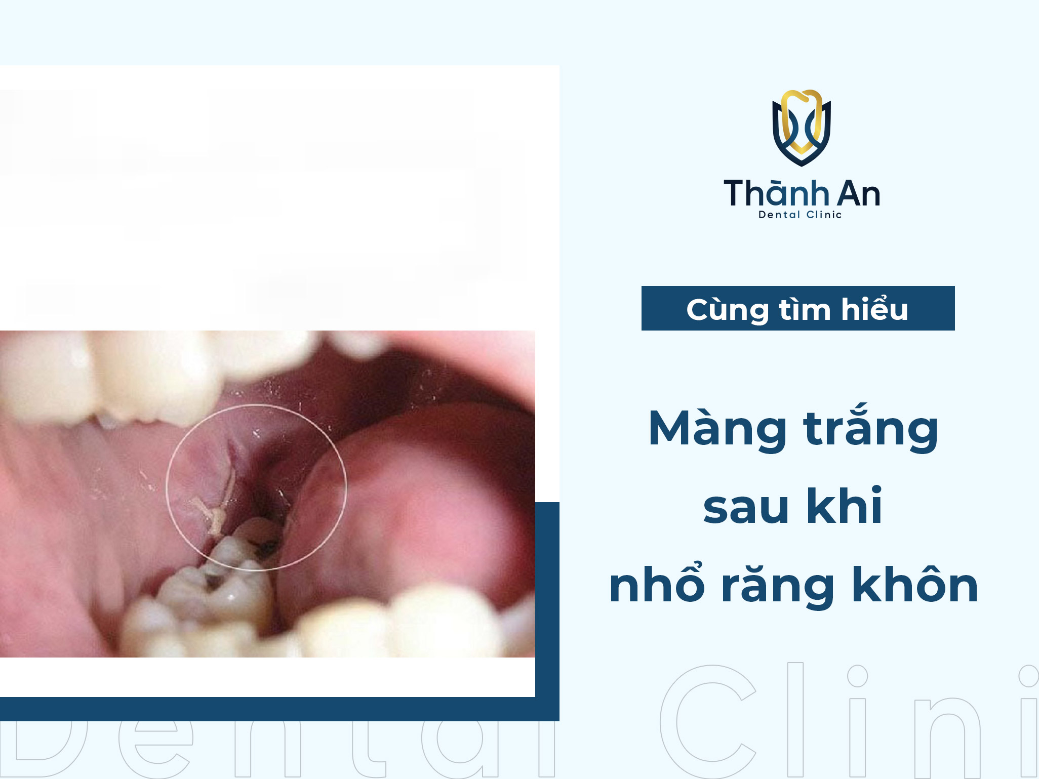 Xuất hiện màng trắng sau khi nhổ răng khôn do đâu