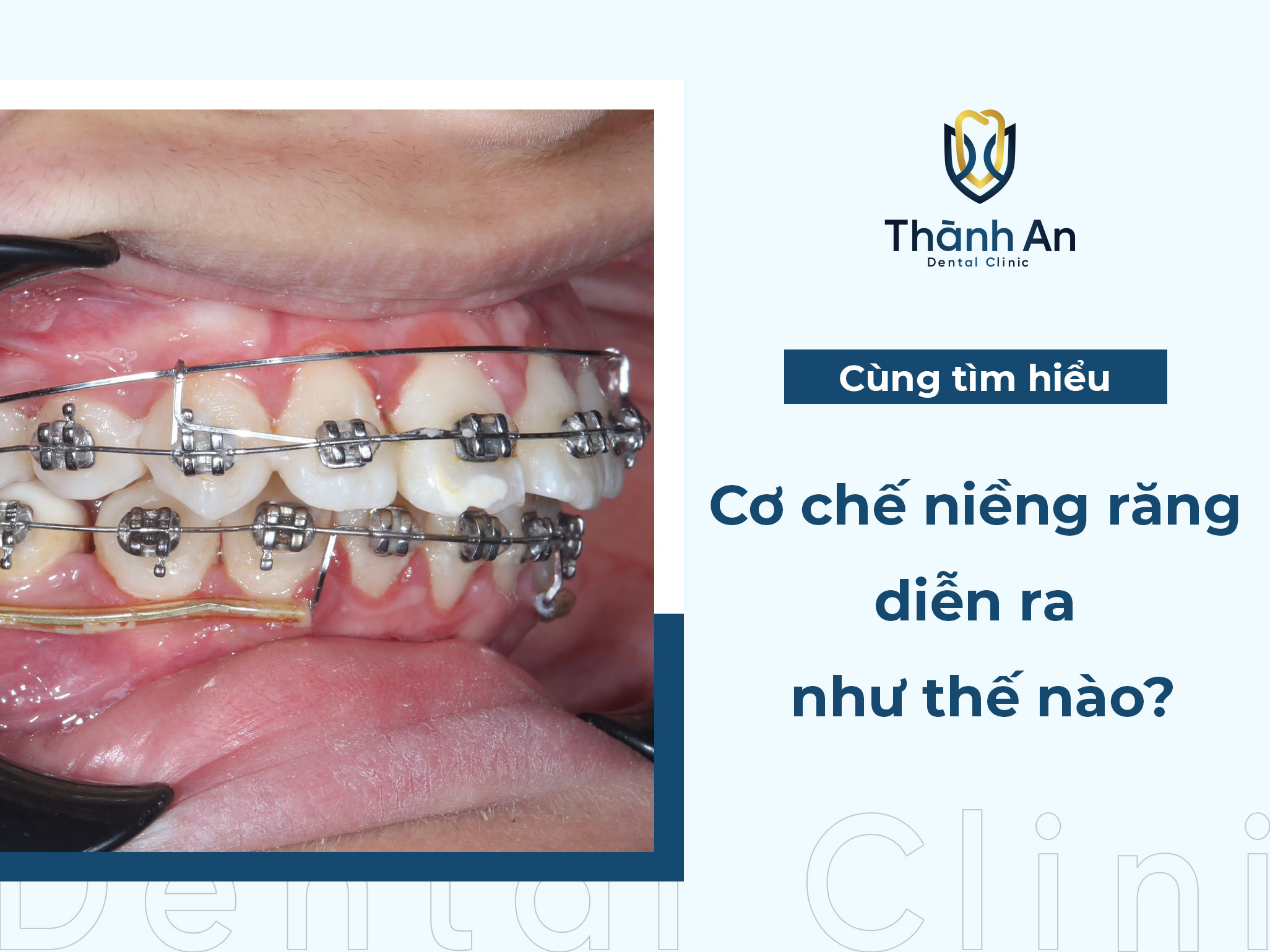 [Hỏi- Đáp] Cơ chế niềng răng diễn ra như thế nào ?