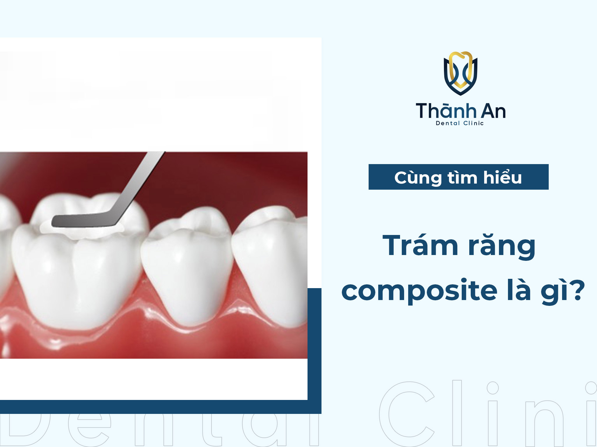 Trám răng composite là gì? những thông tin bạn nên biết 