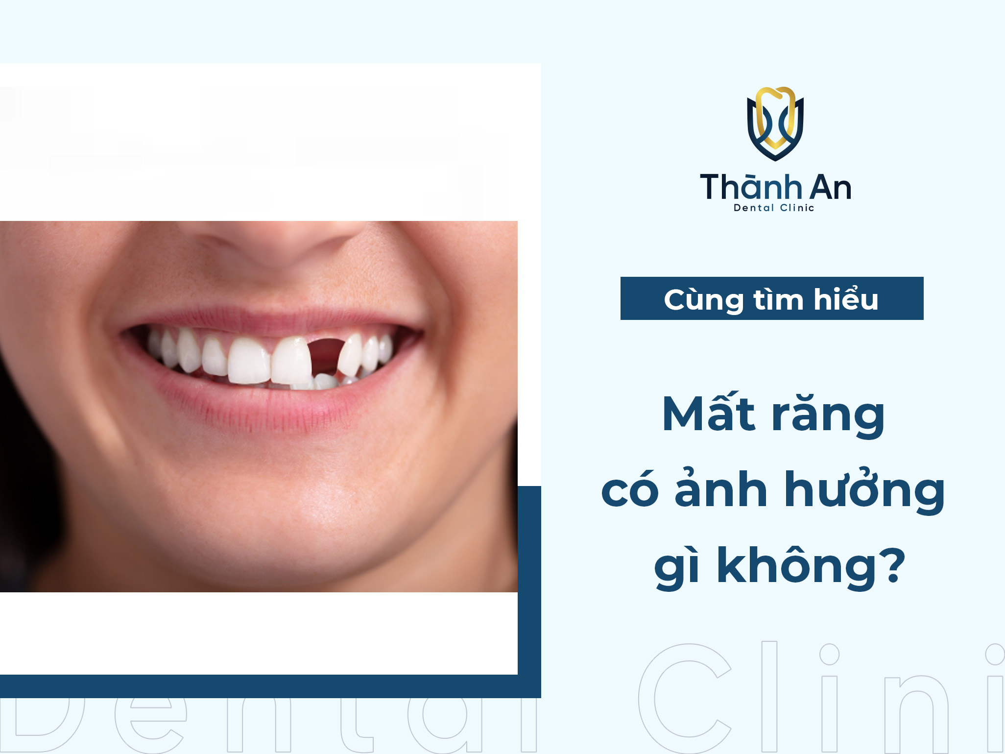 Hậu quả mất răng đừng xem thường nếu bạn chưa biết điều này