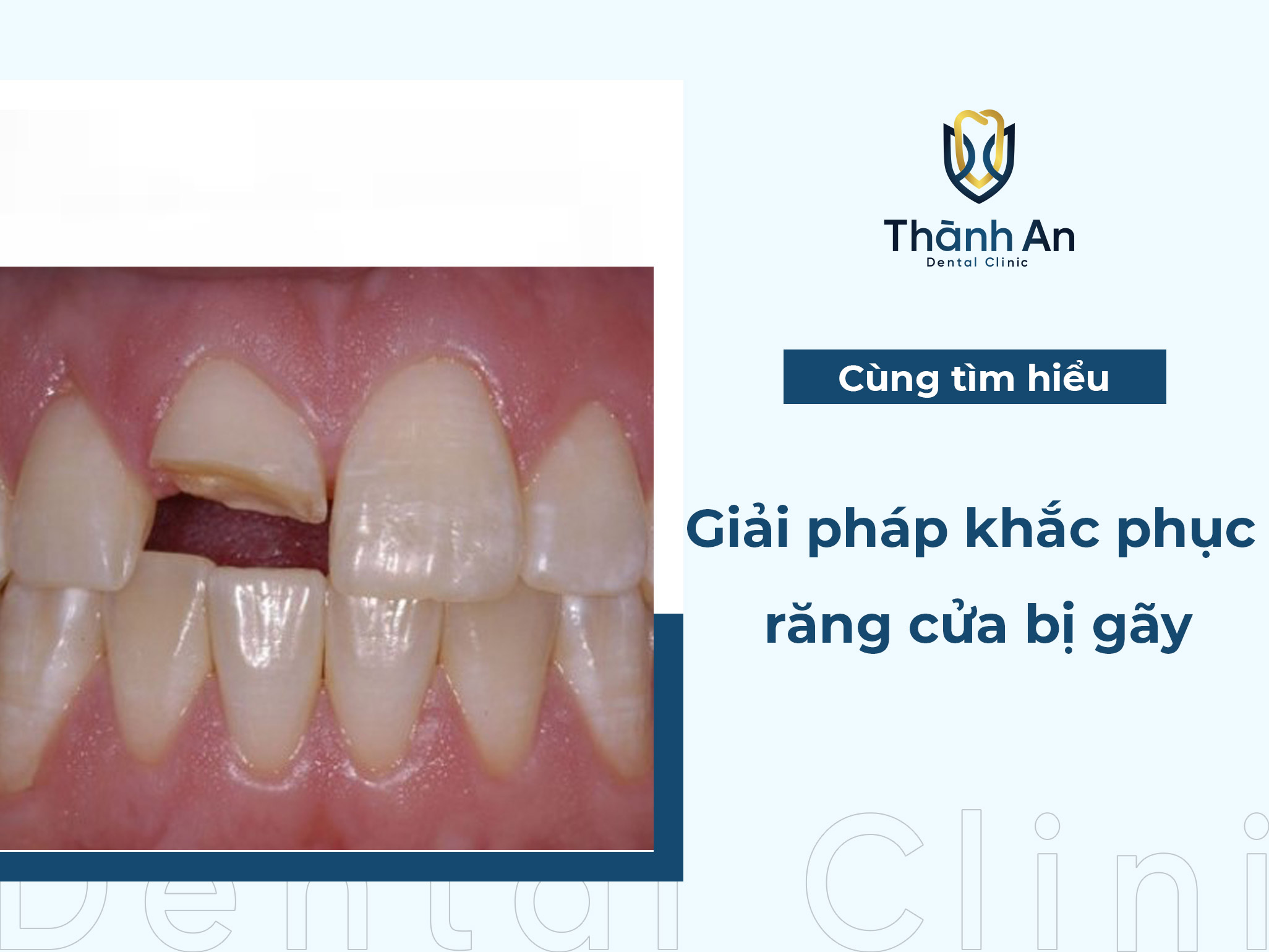 Kiểu răng cửa bị gãy thường gặp và phương pháp khắc phục HIỆU QUẢ