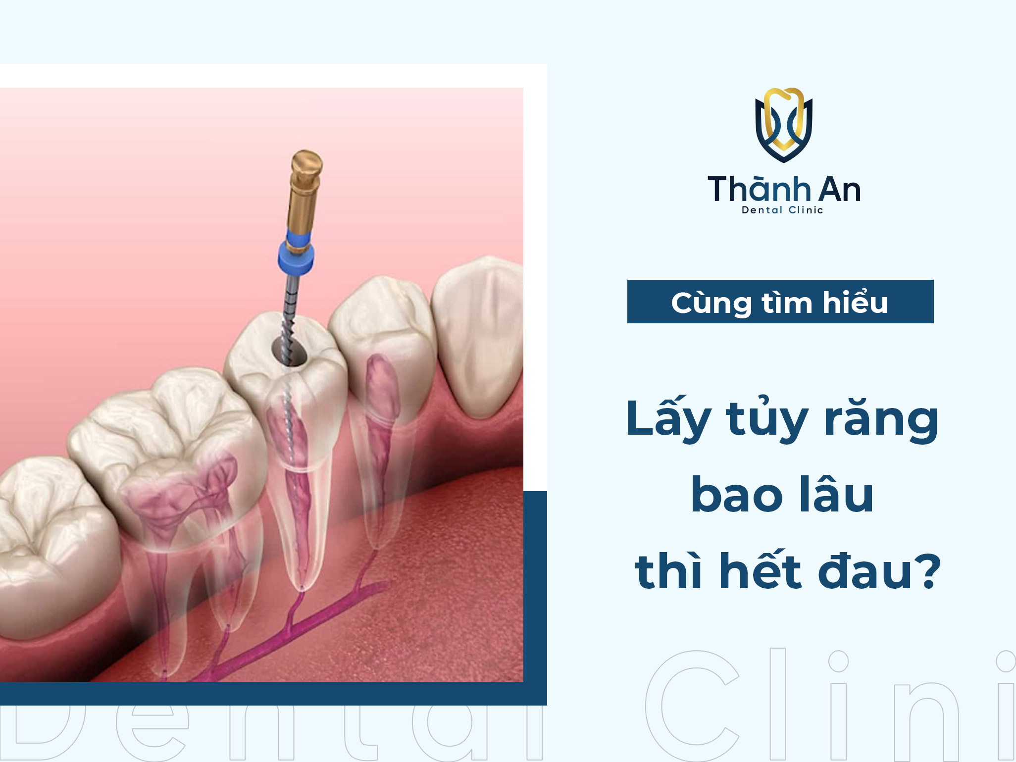 Lấy tủy răng bao lâu thì hết đau? cần điều trị bao nhiêu lần