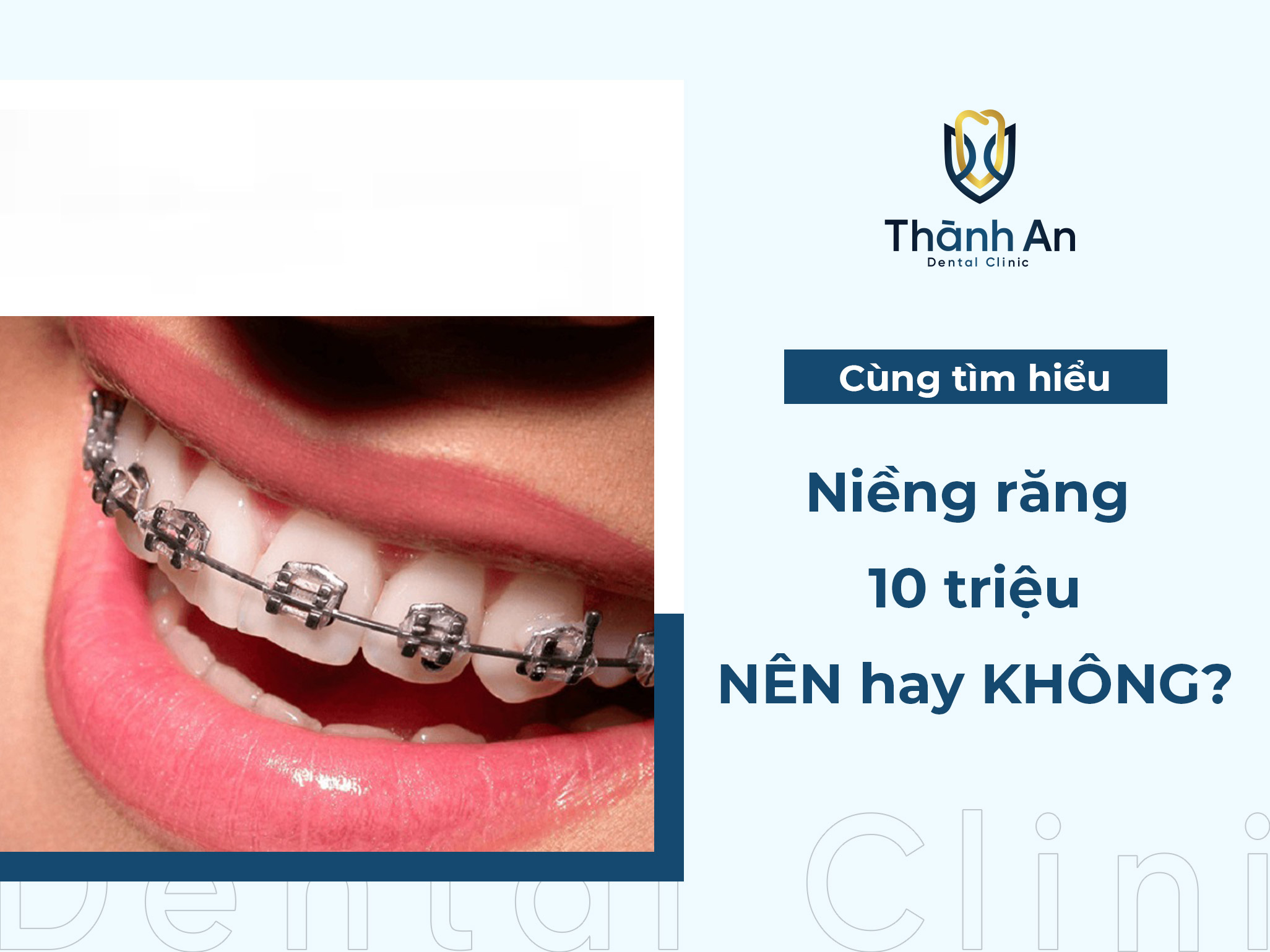 Niềng răng 10 triệu: An toàn và hiệu quả thực sự như thế nào?