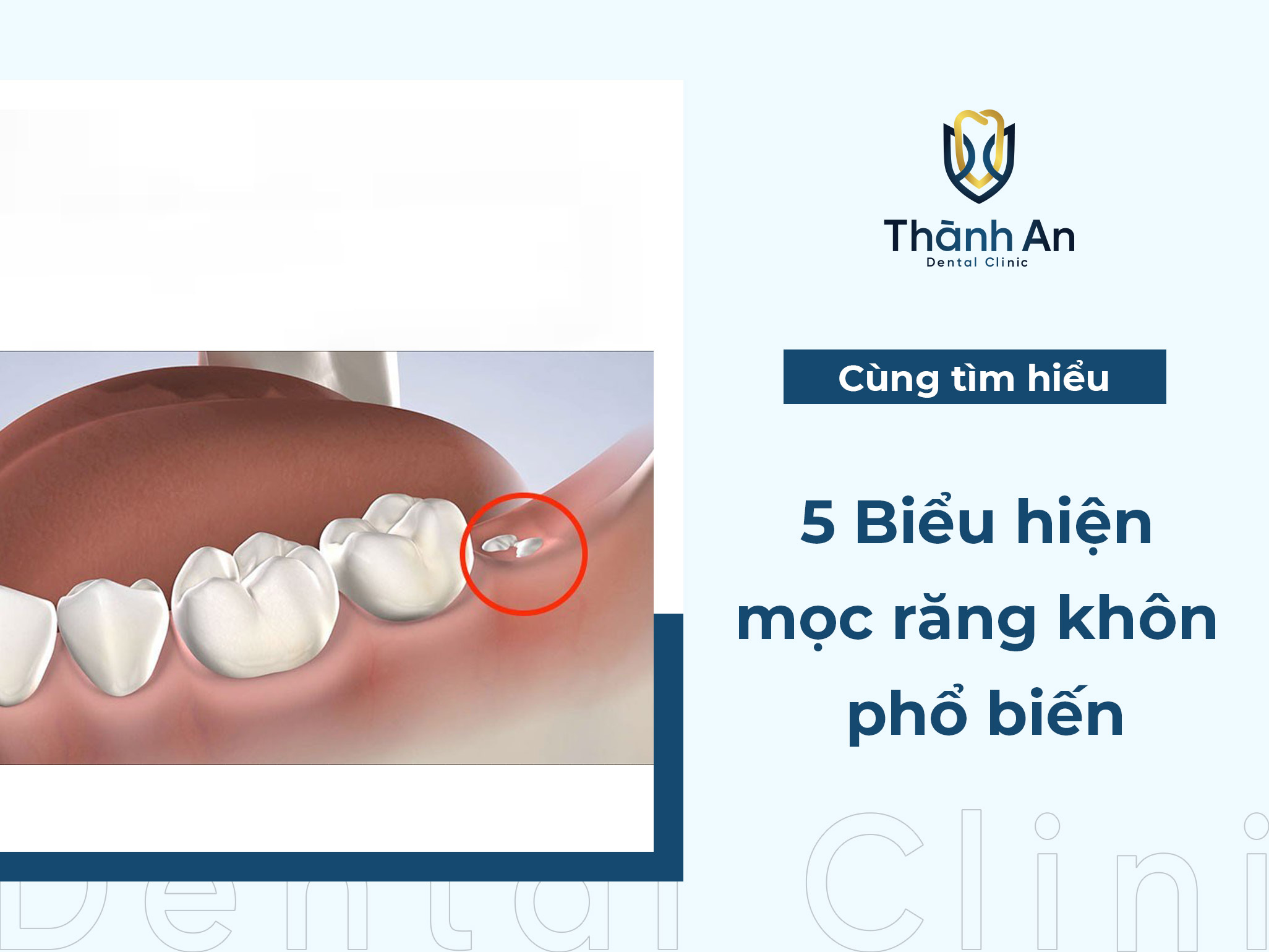 5+ biểu hiện mọc răng khôn phổ biến dễ nhận biết
