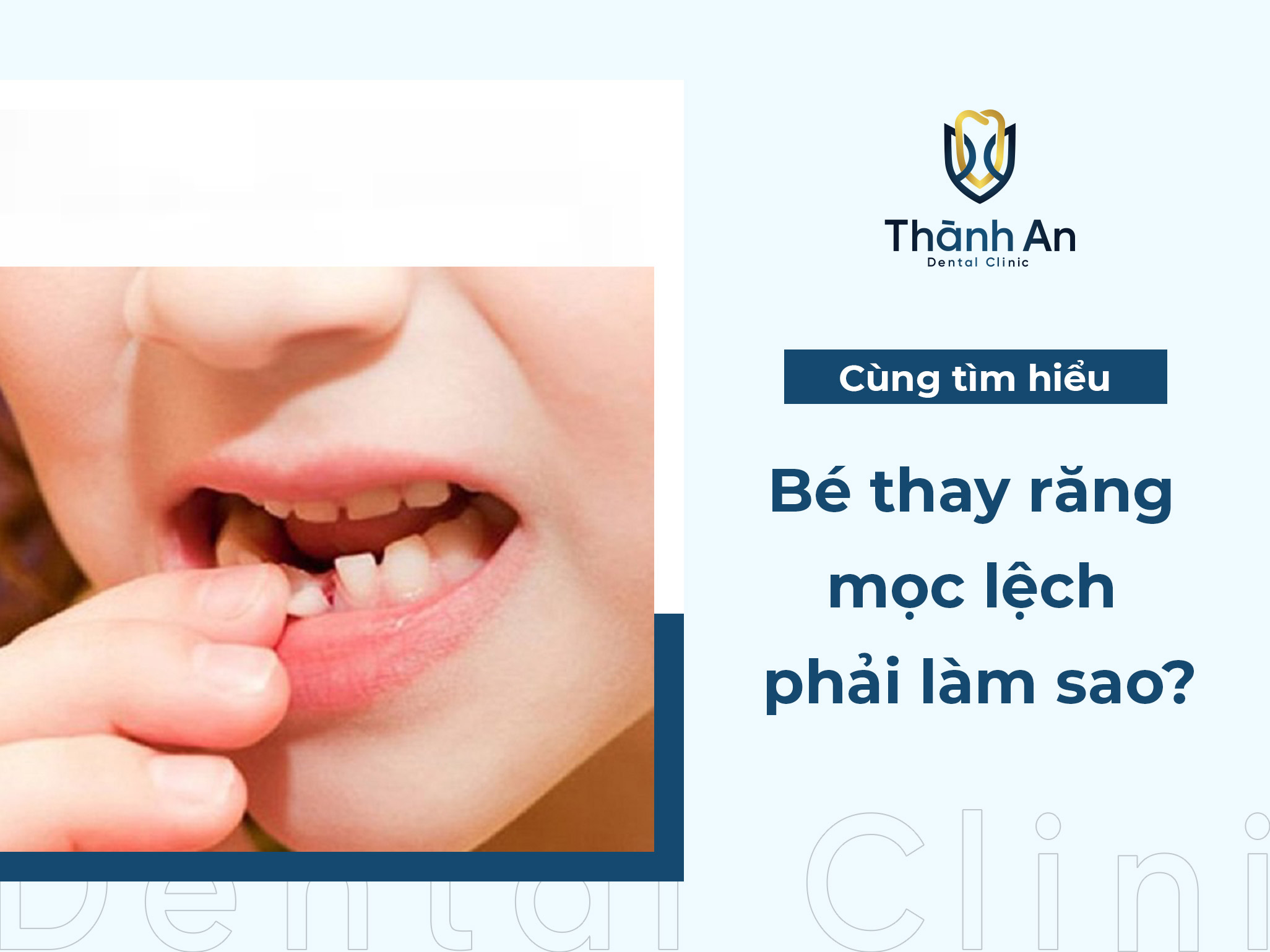 Bé thay răng mọc lệch phải làm sao? Nguyên nhân và cách khắc phục