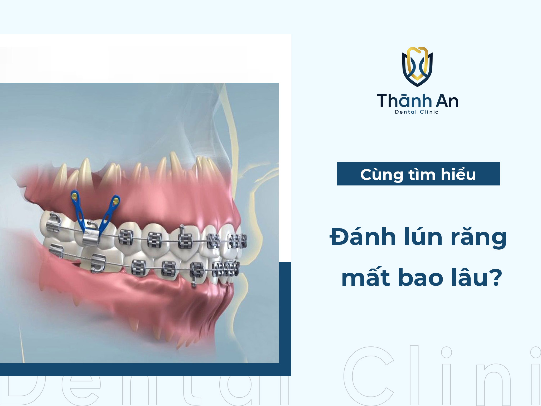 Kỹ thuật đánh lún răng mất bao lâu?