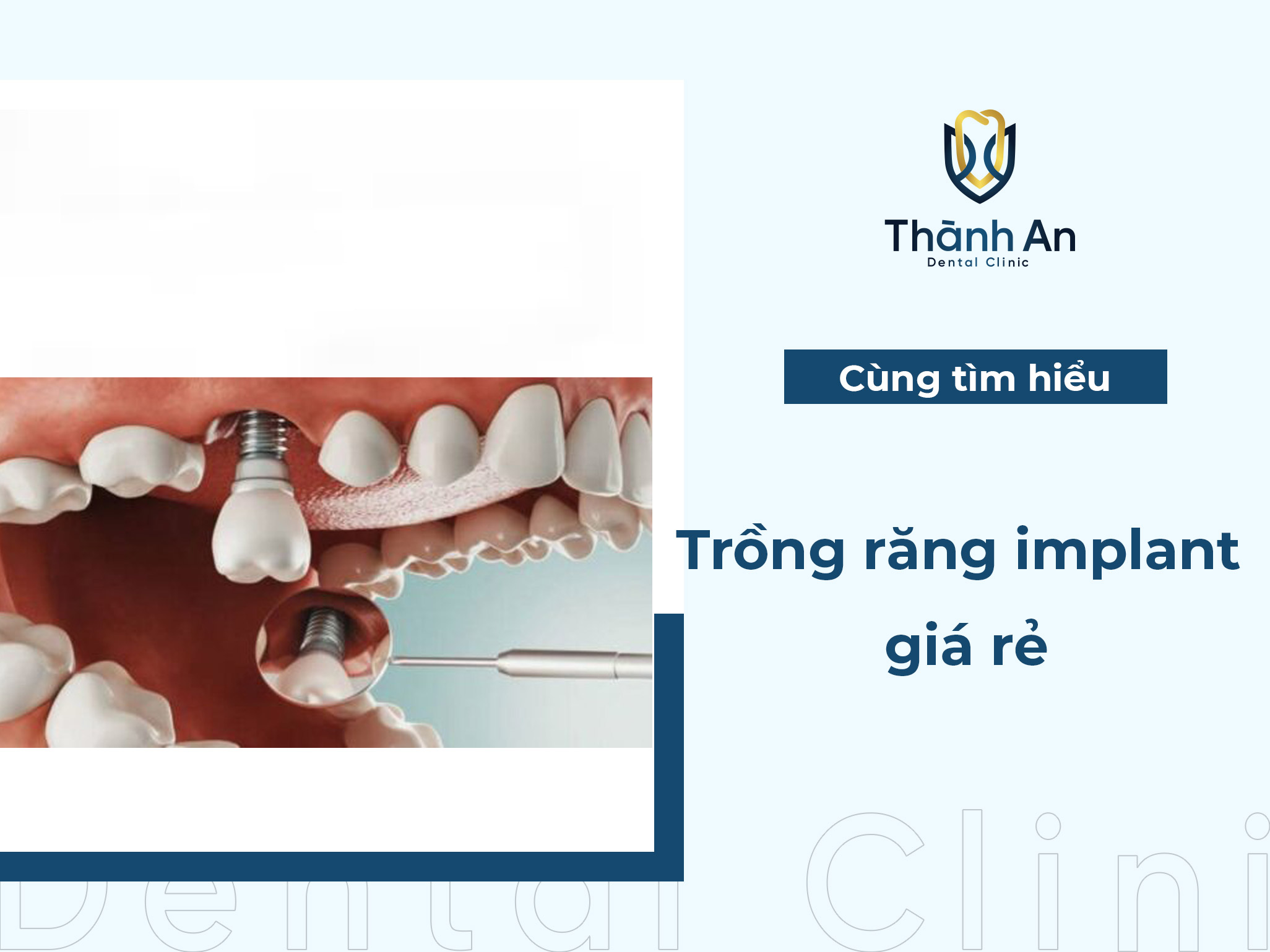 Trồng răng Implant giá rẻ, an toàn ở đâu Hà Nội?