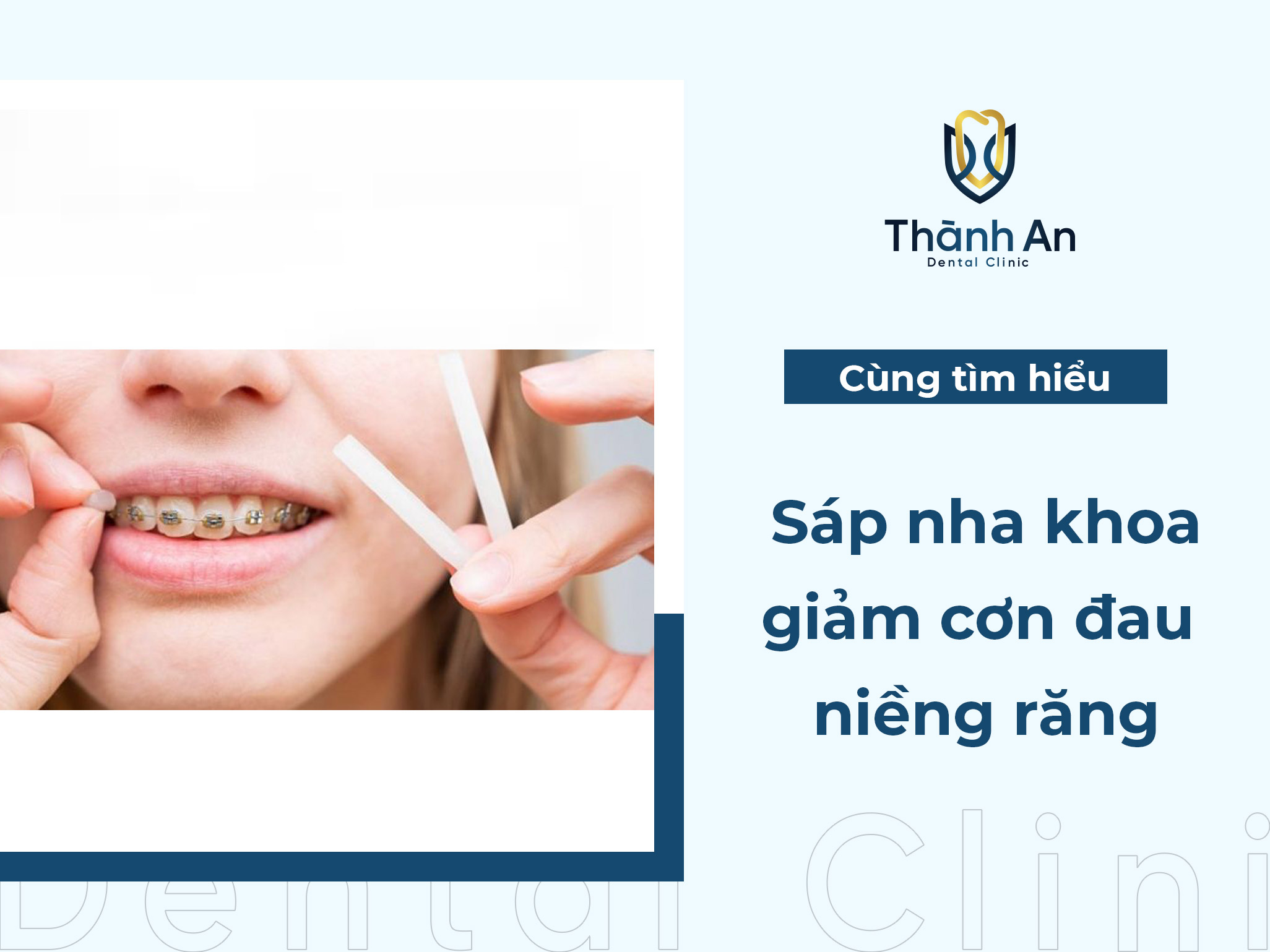 Sáp nha khoa - Dùng đúng cách, giảm cơn đau niềng răng hiệu quả