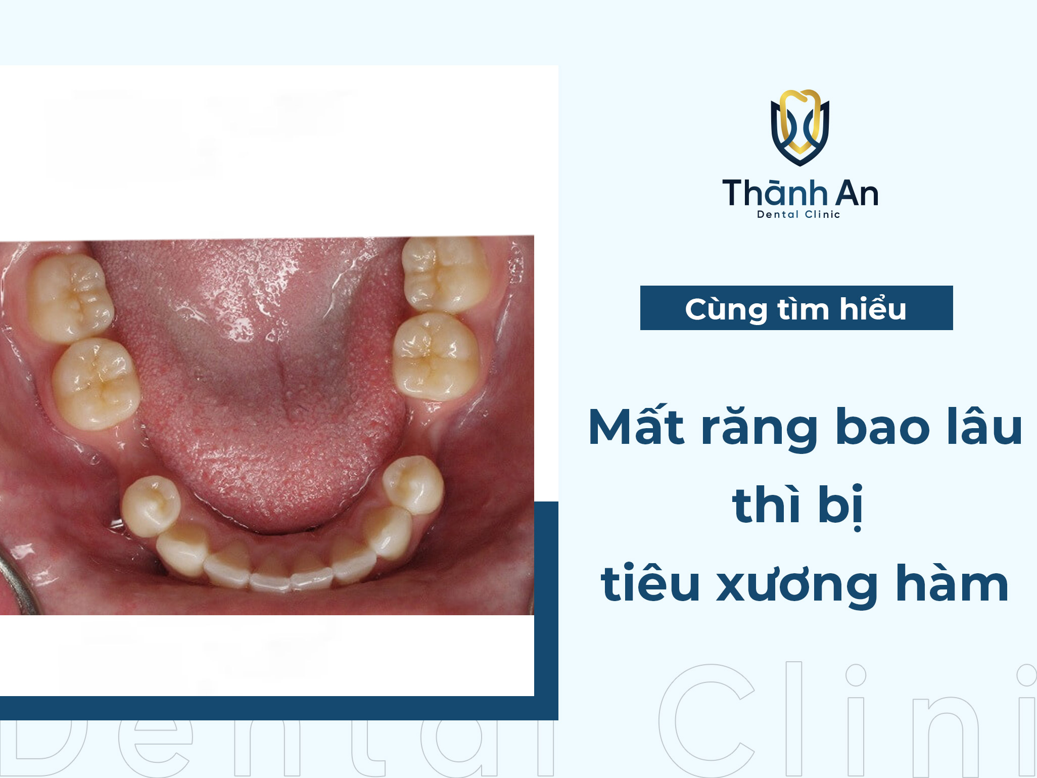 Mất răng bao lâu thì bị tiêu xương hàm? phương pháp khắc phục