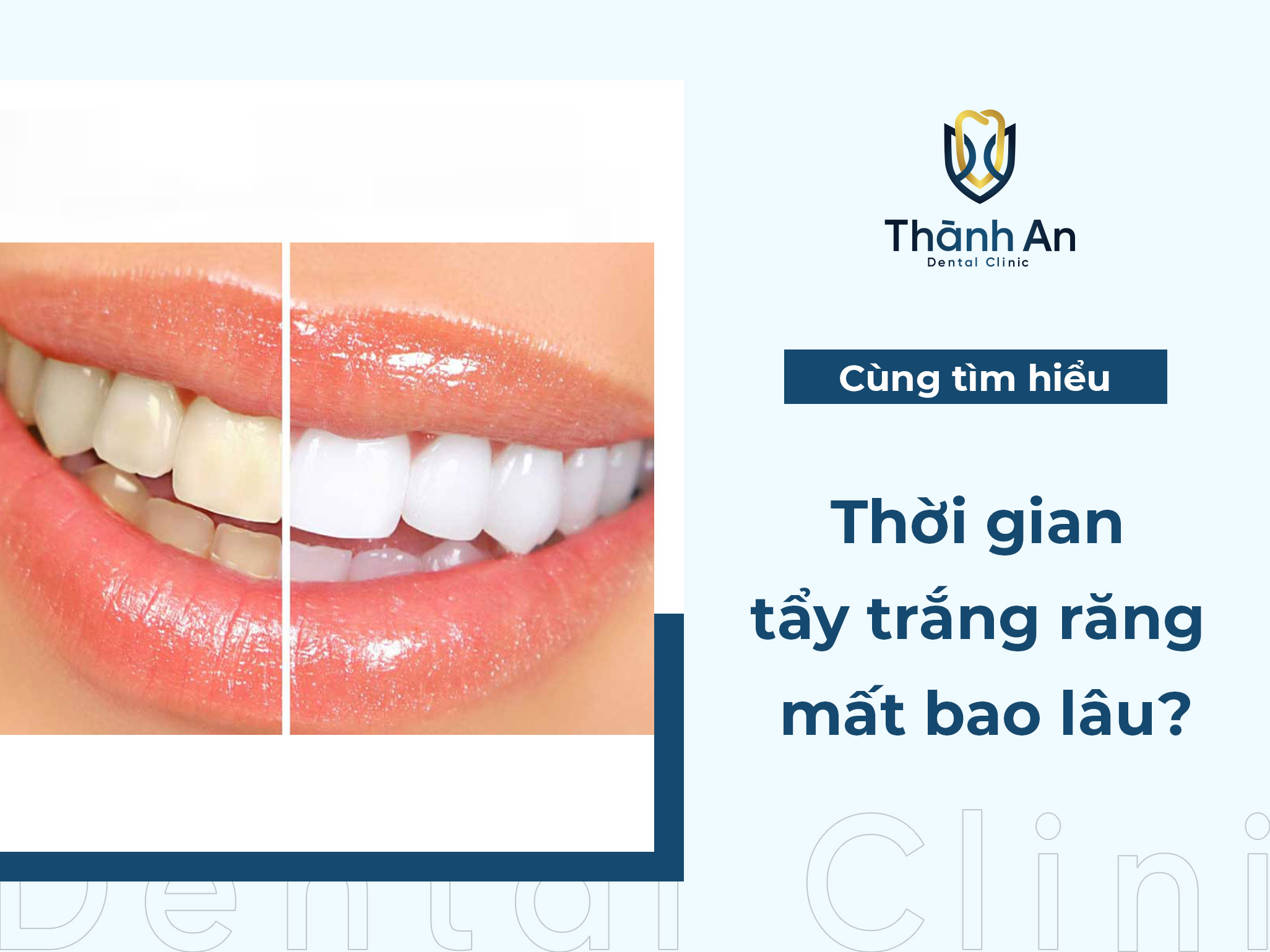 Thời gian tẩy trắng răng mất bao lâu đạt hiệu quả?
