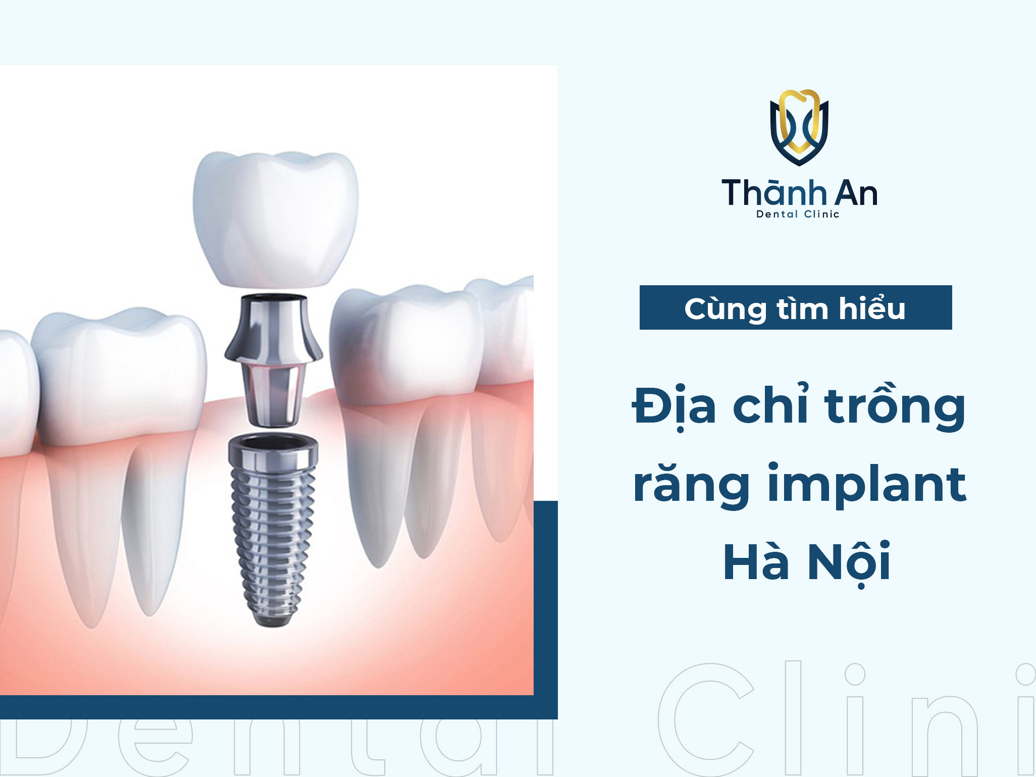 Top 3+ Địa chỉ trồng răng implant Hà Nội uy tín