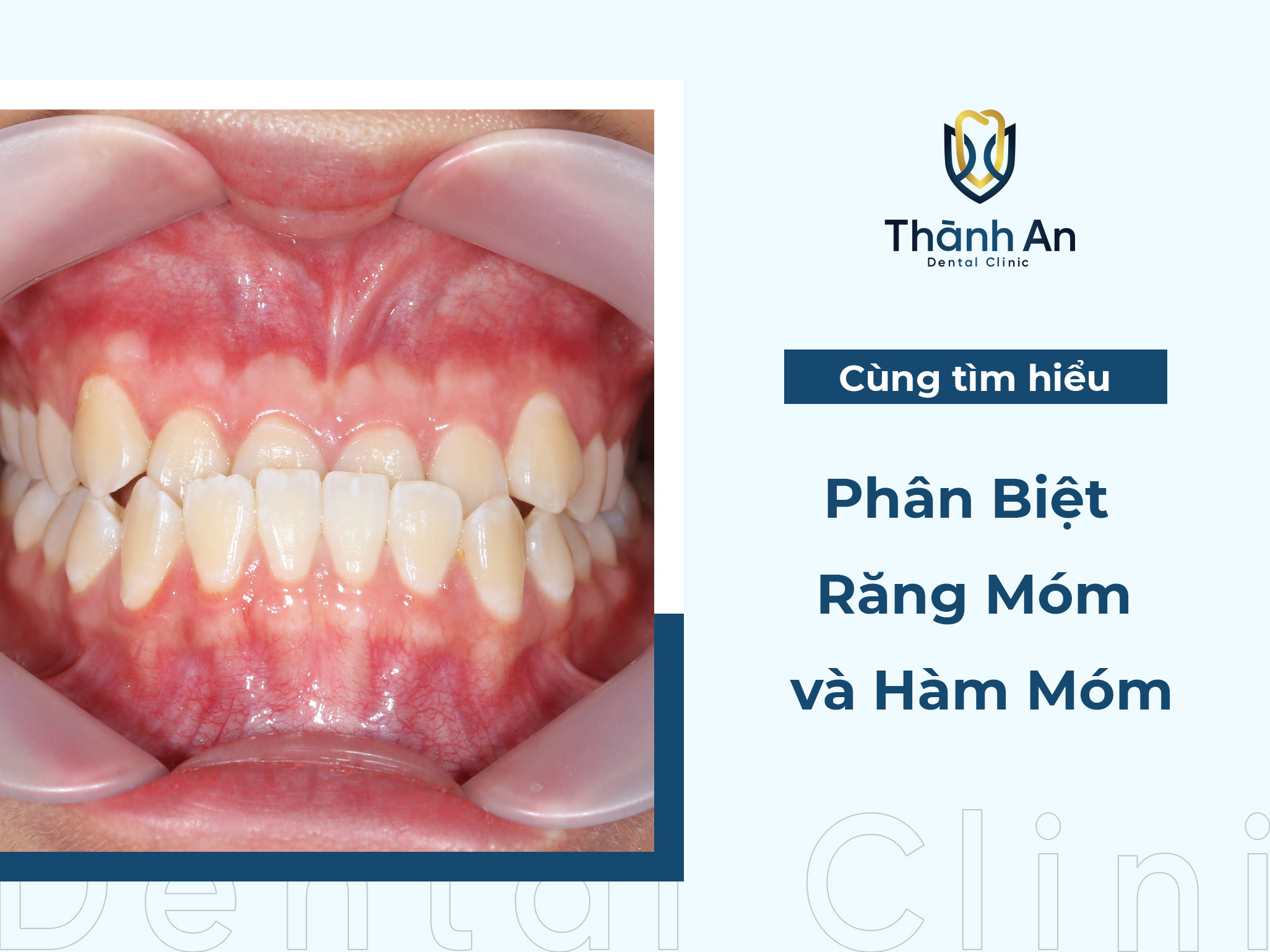 Phân biệt răng móm và hàm móm theo tiêu chí nào?