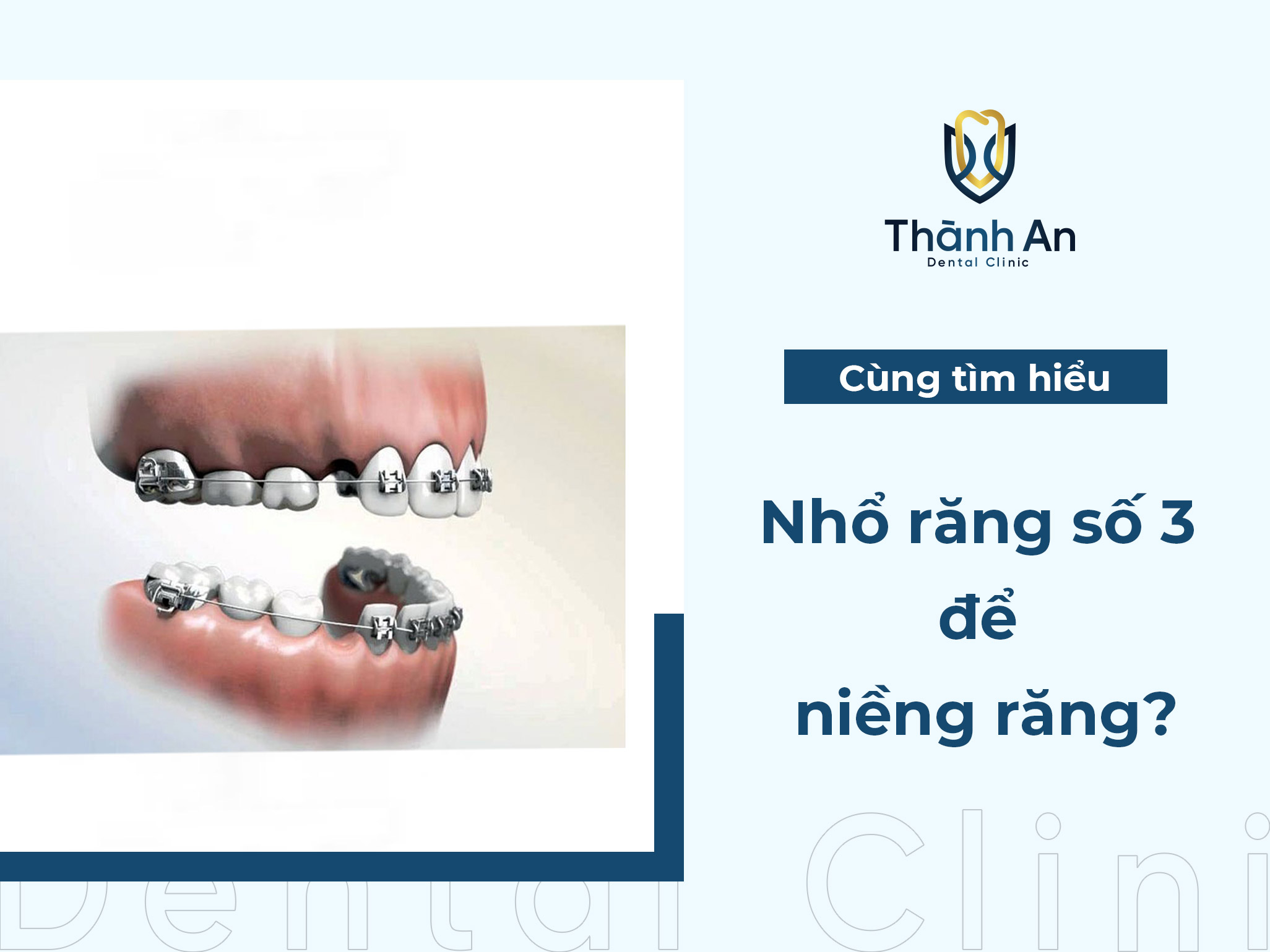 Nhổ răng số 3 để niềng răng nên hay không? trường hợp nào cần nhổ?