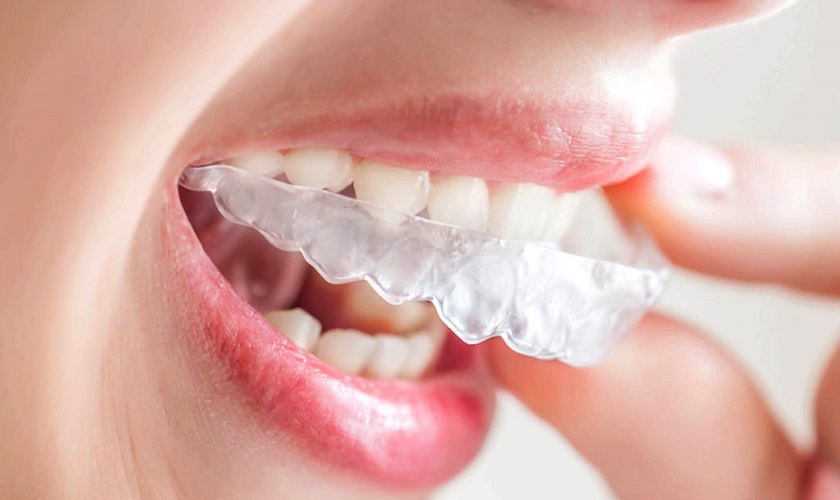 nieng-rang-invisalign-1-ham