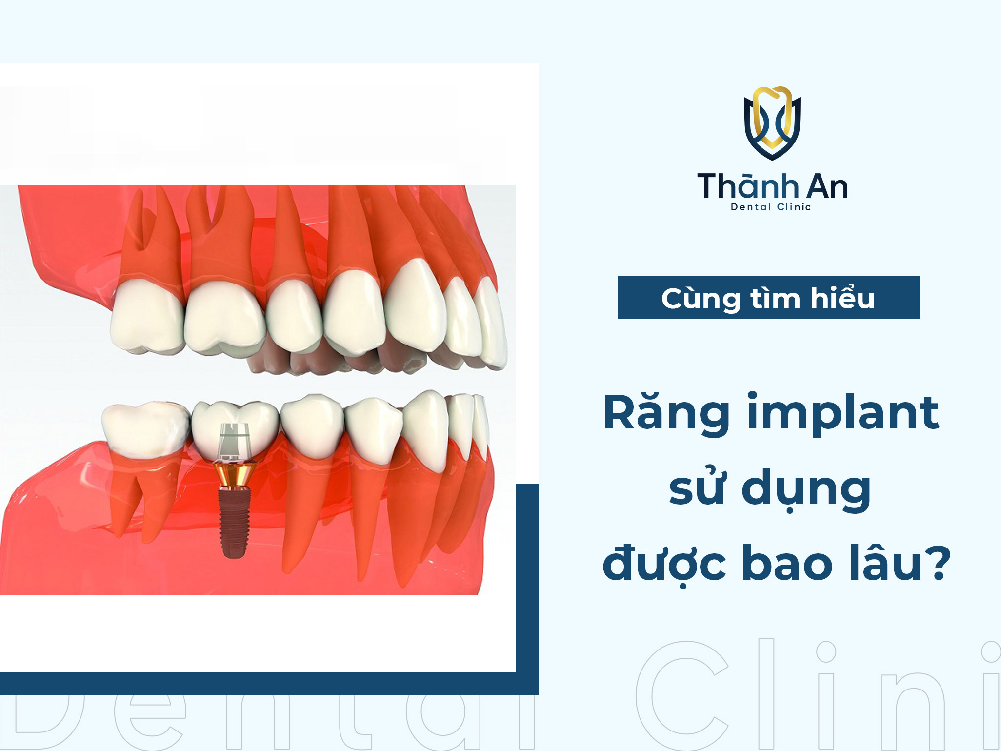 Tuổi thọ Răng implant sử dụng được bao lâu?