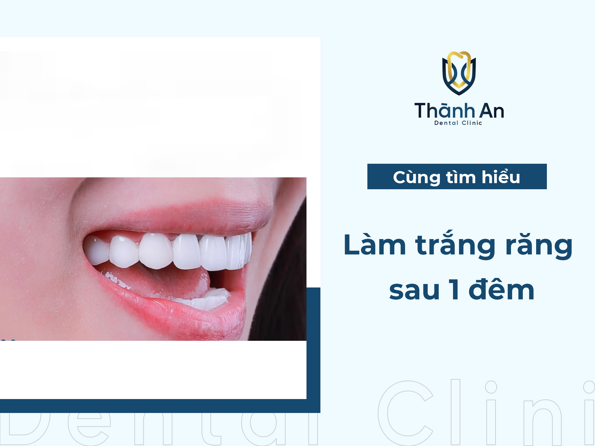 Mách bạn cách làm trắng răng sau 1 đêm từ bác sĩ nha khoa