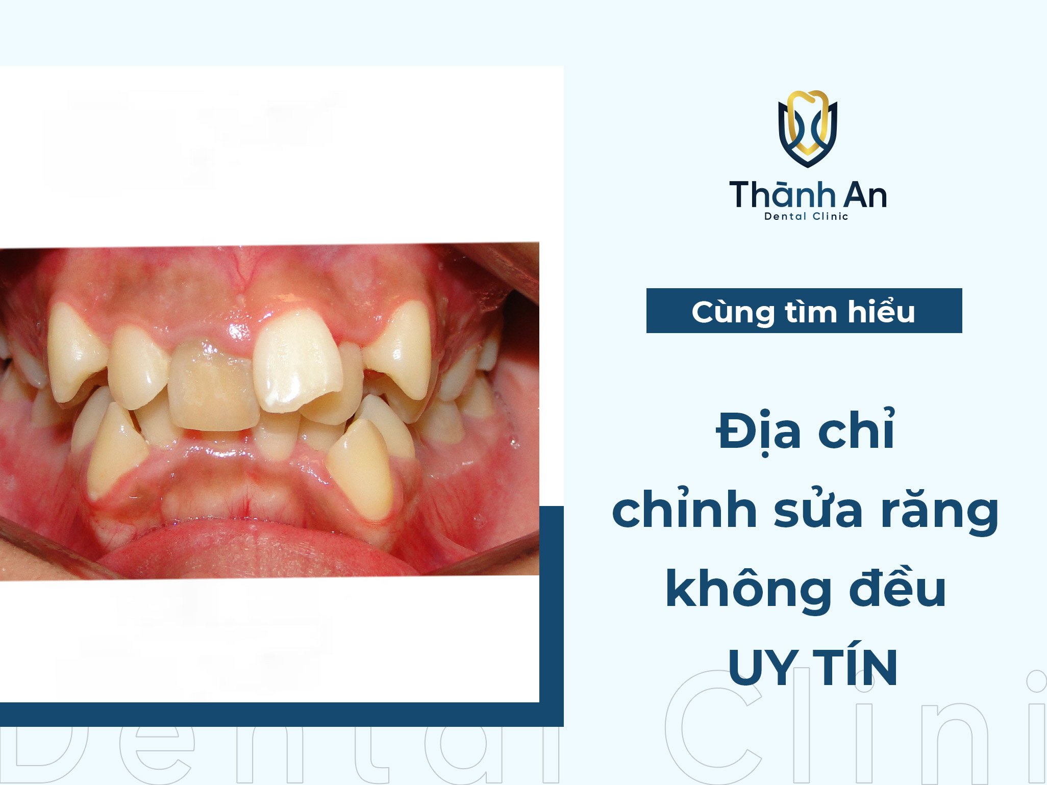 Địa chỉ chỉnh sửa răng không đều uy tín, chất lượng hàng đầu tại Hà Nội