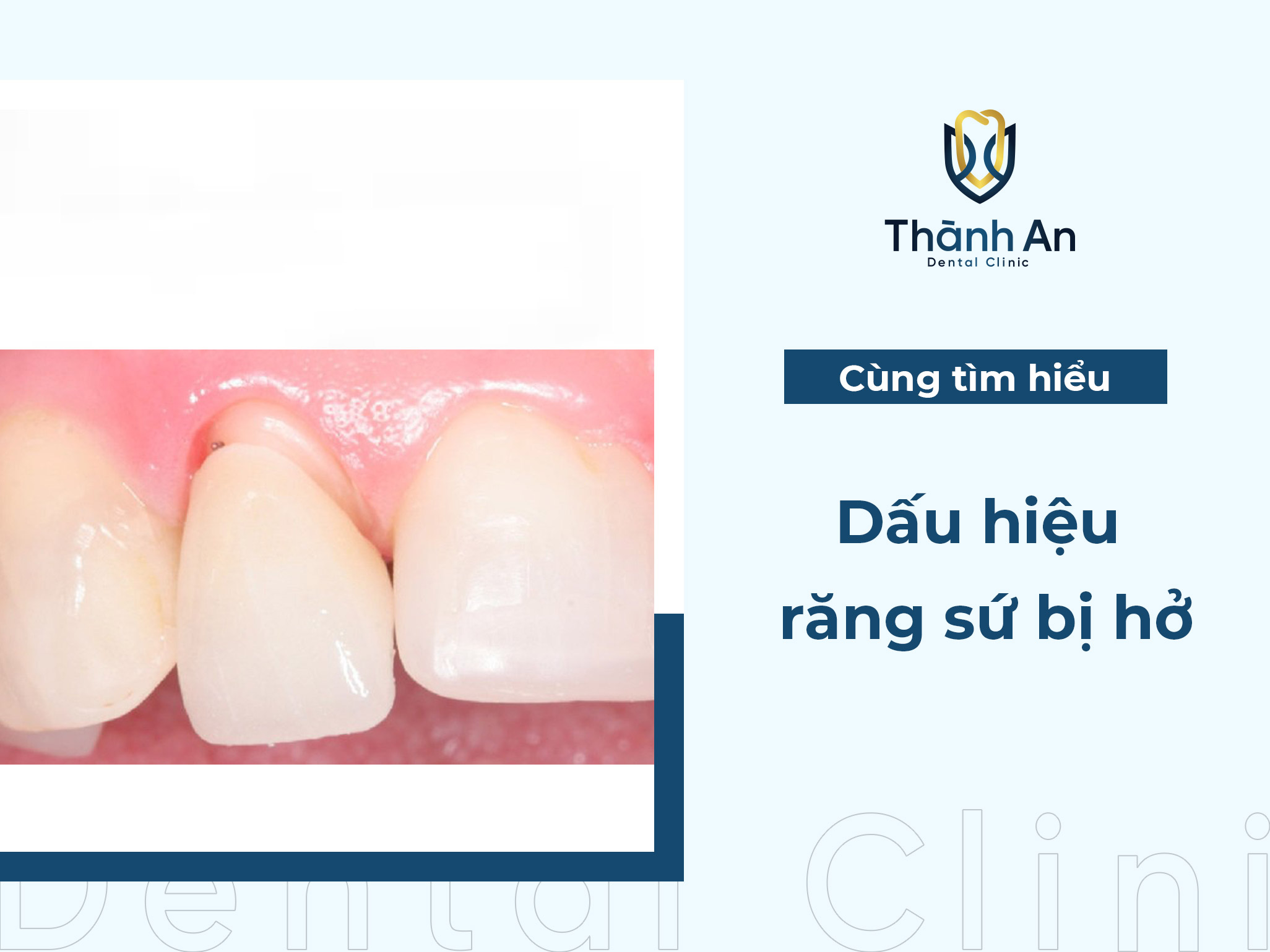 Nhận biết dấu hiệu răng sứ bị hở và cách khắc phục