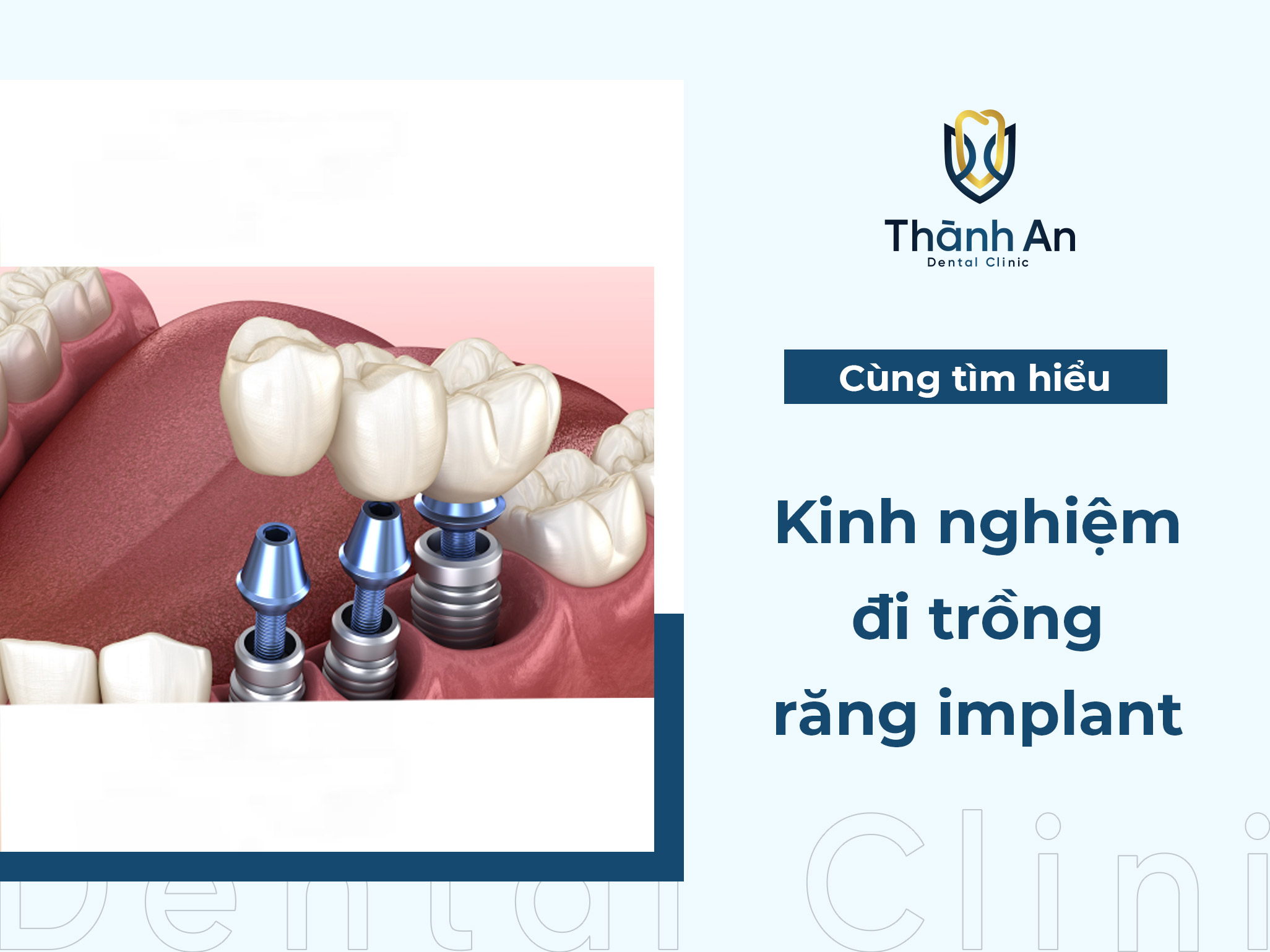 Kinh nghiệm đi trồng răng implant HIỆU QUẢ - AN TOÀN, bạn đã biết